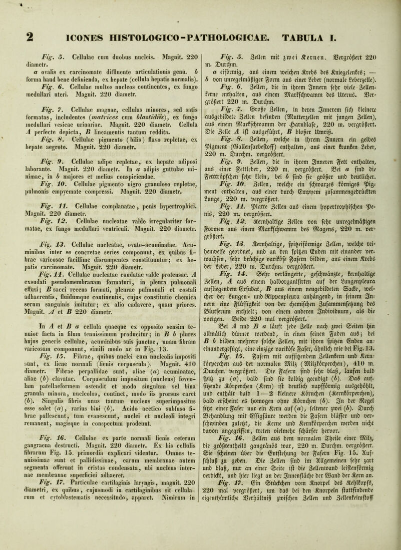 Fig. o. Cellulae cum duobus nucleis. Magnit. 220 diametr. a ovalis ex carcinomate difiluente articulationis genu, b forma haud bene definienda, ex hepate (cellula hepatis normalis). Fig. 6. Cellulae multos nucleos continentes, ex fungo medullari uteri. Magnit. 220 diametr. Fig. 7. Cellulae magnae, cellulas minores, sed satis formatas, includentes (tnatrices cum blastidiis), ex fungo medullari vesicae urinariae. Magnit. 220 diametr. Cellula A perfecte depicta, B lineamentis tantum reddita. Fig. 8. Cellulae ])igmento (bilis) flavo repletae, ex hejiate aegroto. Magnit. 220 diametr, Fig. .9. Cellulae adipe repletae, ex hepate adiposi laborante. Magnit. 220 diametr. In a adipis guttulae mi- nimae, in b majores et melius conspiciendae. Fig. 10. Cellulae pigmento nigro granuloso repletae, pulmonis empyemate compressi. Magnit. 220 diametr. Fig. 11. Cellulae complanatae, penis hypertrophici. 3Iagnit. 220 diametr. Fig. 12. Cellulae nucleatae valde irregulariter for- matae, ex fungo medullari ventriculi. Magnit. 220 diametr. Fig. 13. Cellulae nucleatae, ovato-acuminatae. Acu- minibus inter se concretae series componunt, ex quibus fi- brae varicosae facillime disrumpentes constituuntur; ex he- patis carcinomate. Magnit. 220 diametr. Fig. 14. Cellulae nucleatae caudatae valde protensae. A exsudati psendoraembranam formaturi, in pleura pulmonali effusi; B sacci recens formati, pleurae pulmonali et costali adhaerentis, fluidnmque continentis, cujus constitutio chemica serum sanguinis imitatur; ex alio cadavere, quam priores. Magnit. A ci B 220 diametr. In A et ^ a cellula quaeque ex opposito sensim te- nuior facta in filum tenuissimum producitur; 'm B b plures hujus generis cellulae, acuminibus suis junctae, unam fibram varicosam componunt, simili modo ac in Fig. 13. Fig. 15. Fibrae, quibus nuclei cum nucleolis impositi sunt, ex liene normali (lienis coiqiuscula). Magnit. 410 diametr. Fibrae perj)allidae sunt, aliae (a) acuminatae, aliae (i) clavatae. Corpusculum impositum (nucleus) foveo- lam ])atellaeformem ostendit et modo singulum vel bina granula minora, nucleolos, continet, modo iis prorsus caret (b). Singulis fibris unus tantum nucleus superimpositus esse solet (a), rarius bini {b). Acido acetico subfuso fi- brae pallescunt, tum evanescunt, nuclei et nucleoli integri remanent, magisque in conspectum prodeunt. Fig. 16. Cellulae ex parte normali lienis ceterum gangraena destructi. Magnit. 220 diametr. Ex bis cellulis fibrarum Fig. 15. primordia explicari videntur. Omnes te- nuissimae sunt et pallidissimae, carum membranae autem segmenta offerunt in cristas condensata, ubi nucleus inter- nae membranae superficiei adhaeret. Fig. 17. Particulae cartilaginis laryngis, magnit. 220 diametri, ex quibus, cujusmodi in cartilaginibus sit cellula- rum et cytoblastematis necessitudo, apparet. Nimirum in Fig. 5. 3eUen mit jmei .Lernen. SSevgrofevt 220 m. S)urc^m. a eiförmig, auö einem meidjen Äreb§ beö ÄniegelenfeS; — b non unregelmdpiger §orm auö einer 2eber (normale SeberjeUe). Ftg. 6. 3cflfn, bie in i^rem Snnern fe^r oicle 3eUcn= ferne entljalten, aue einem 9)?arffd)mamm beö Uteruö. SSer^^ gropert 220 m. 3)urd)m. Fig. 7. ©rope 3ellen, in beren innerem fidy fleinere auögebilbetc 3eflen befinben (SKutterjellen mit jungen 3ellen), auö einem 9)?arffd)mamm ber ^arnblafe, 220 m. oergropert. 2!)ie 3elle A ift auögefüljrt, B bloper Umrip. Fig. 8. 3eUen, welche in iprem Snnern ein getbeS Pigment (©allenfarbeftoff) enthalten, auö einer franfen ßeber, 220 m. ^ur(^m. oergropert. Fig. 9. 3ellen, bie in ifjrem Snneren §ett entfjalten, au§. einer ^ettleber, 220 m. oergropert. 93ei a [tnb bie §efttr6pfd;en fe^r flein, bei b ftnb ftc groper unb beutlid)er. Fig. 10. 3eflen, meld)c ein fdjwarjeö förnigeö ^ig= ment entfjalten, auö einer burd) @mpi)em jufammengebrüeften ßunge, 220 m. »ergropert. Fig. 11. glatte 3eflen auö einem Ijppertrop^ifdjen ^e= niö, 220 m. oergropert. Fig. 12. Äernfjaltige 3ellfn oon fefjr unregelmdpigen formen auö einem Sliarffc^mamm beS 9)tageng, 220 m. ner= gropert. Fig. 13. Äern^altige, fpipeiformige 3ellen, welche rei- ^enmeife georbnet, unb an ben fpi|en ©nben mit einanber r»er= mac^fen, fef;r brudjige oariföfe gafern bilben, auö einem .^reb6 ber Seber, 220 m. £iurd^m. oergropert. Fig. 14. ©e^r oerldngerte, gefd)n>dnjte, fernfjattige 3elfen, A auö einem ^alborganiftrten auf ber Sungenpleura aufliegenbem ©rfubat, B auö einem neugebilbeten ©aefe, mel- d)er Der Sungen = unb SJippenpleura an^dngenb, in feinem nern eine glüffigfeit oon ber ^emif^en 3ufammenfe|ung beö S3lutferum entl)ielt; oon einem anberen Snbioibuum, al6 bie oorigen. S3eibe 220 mal »ergropert. 93ei A nnb B a Iduft jebe 3elle nad) jmei ©eiten f)in allmdli(^ bunner merbenb, in einen feinen ^aben aug; bei B b bilben meljrerc fold)c 3ellen, mit il)ren fpipen ©nben an= einanbergefügt, eine einzige oarifofe ^afer, dljnli^ mie bei Fig. 13. Fig. 15. g'afern mit auffi^enbem 3ellenfern unb Äern- forperd)en auö ber normalen 5)?il5 (Sfltil}!6rperd)en), 410 m. 2)urd)m. oergropert. ®ie ^afern j^inb fef>r blap, laufen halb fpi^ ju (a), halb finb ftc folbig geenbigt (i). 25aö auf= jtpenbe .^tdrperd)en (Äern) ift beutlid) napffdrmig auögcl)6plt, unb entljdlt halb 1—2 fleinerc .S6rnd)en (Äernförperd)cn), halb erf(^eint eö Ijomogen opne .^orndpen (6). Sn ber Siegel fipt einer g'afer nur ein Äern auf (a), feltener jwei (d). 2)urd; 93el)anblung mit ©ffigfdurc merben bie gafern bldffer unb oer= fd)tt)inben jule^t, bie Äernc unb Äernfdrper^en werben nid;t baoon angegriffen, treten oielmel;r fdjdrfer Ijeroor. Fig. 16. 3ellen auö bem normalen SSpcile einer SOtilj, bie gr6ptentl;eilö gangrdnoö mar, 220 m. ^Durt^m. oergrdpert. ©ic fd)einen über bie @ntftel;ung ber ^afern Fig. 15. 2Cuf= fd)lup ju geben. iDic 3ellen finb im 5fllgemeinen fepr jart unb blap, nur an einer ©eite ift bie 3ellenmanb leiftenförmig »erbieft, unb l)ier liegt an ber Snnenfldd)e ber 2Banb ber .S'ern an. Fig. 17. ©in ©tücfd)en oom .Knorpel beö Äefjtfopfö, 220 mal oergropert, um baö bei ben Änorpeln ftattfinbenbe eigentf)ümlicfic SI?erl;dltnip gmifd)en 3fllpn unb 3ellenfeimffoff