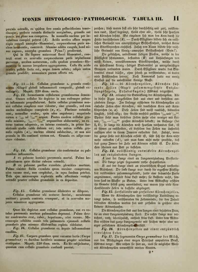 |)iiscula ostendit, ea quidem fere omnia pellucidissima tener- rimaque, perfecte rotunda distinctis marginibus, granulis aut ])aucis aut j)lane non conspersa. In nonnullis nucleus per in- volucrum conspici poterat (^1). Acido acetico affuso magna copia coaguli amorpho-filamentosi, corpusculorum puris nu- cleos involventis, concrevit. Alumine addito coagula haud mi- nus copiosa, amorpho-granulosa (Pyina?) prodierunt. Qui in illo liquore nataverant flocci lllamentosi, con- texti erant ex acervulis corpusculorum jiuris utplurimum parvorum, necdum maturorum, colla quadam granuloso-fila- mentosa in massas irregulares aggregatorum. Colla illa acido acetico pallida facta est, neque tamen soluta; adipis autem granula prodidit; amraoniaco parum affecta est. Fig. 13 —16. Cellulae granulosae s. granula conti- nentes {Glugii globuli inflammatorii compositi, globuli cx- sudatofii). Magnit. 220 diam, aucta. Fig. IS, formationem cellularum granulosarum demon- strat. Omnes cellulae hic depictae in uno eodemque pulmo- ne inflammato propullularunt. Initio cellulae granulosae non- nisi cellulae simplices esse videntur, sine granulis, sed cum nucleo nucleolisque conspicuis (a, a). Plurimae rotundae sunt, nonnullae ovales, quin adeo angulosae; magnitudo earum a 7soo aequat. Postea eaedem cellulae gra- nulis minimis, Ygoo — aequantibus obducuntur, an ex- terne tantum adspersis, an interne contentis, in primo for- mationis stadio valde dubium est; tota autem cellula gra- nulis rejileta (»), nucleus obtutui subducitur, et non nisi granula in illa contineri certum est. Granula cx adipe con- stare videntor. Fig. 14. Cellulae granulosae rite conformatae cx pul- monibus inflammatis. A ex pulmone hominis pneumonia mortui. Pulmo he- patisationem quae dicitur rubram ostendit. B ex pulmone puellae exsudato jileuritico mortuae. Pulmo sinister fluido exsudato quam maxime compressus, aere vacuus erat, non crepitabat, in aqua fundum petebat. Tela ejus microscopio explorata nulla affectionis vestigia ostendit praeter cellulas granulosas in ea depositas. Fig. 16. Cellulae granulosae dilabcntcs ac dilapsae. Cellulae granulosae ubi maturae fuerint, membranas amittunt; granula contenta erumpunt, et in acervulos ma- jores minoresve aggregantur. Quae hic depictae sunt cellulae granulosae, eas ex ve- tulae pneumonia mortuae pulmonibus depromsi. Pulmo dex- ter condensatus erat, ruber, hepatizans, aere vacuus. Mi- croscopio adhibito omnis tela ])ulmonaris ejusmodi cellulis granulosis jilus minusve dilabcntibus repleta videbatur. Fig. 16. Cellulae granulosae ex hepate ioflammatione emollito. Fig. 17. Corpora granulosa quae vocantur lactis {Corjys granuleux) ex ductibus lactiferis mammae propter scirrhum exstirpatae. INIagnit. 220 diam, aucta. Ea hic subjiciuntur, quoniam cum cellulis granulosis confundi possint. perrfjen; biefe waren fajf aUe fef)r burd;firf)ti9 unb ^art, men runb, fc^arf begrdnjt, t^eUd o^ne aUe, tf;etlö fe^r fparfam mit Äornc^en befefit. S3ei einjefnen fa^ man ben .^ern buri^ bie bur^fc^einen {A). — ®urd) @fftgfdurc bilbete fid) ein reid;= lid;e§ ©erinnfel non amorp^fabiger SBefe^affen^eit, meld)ed .^erne non ©iterforperdyen einfdjiop. 3ufa| non Ttfaun bilbete fe^r reid;= lid)e ©erinnfel non fornig = amorpher 93efd^a|fen^eit (^pin.?). S)ie gelblichen, unbefiimmt fähigen glocfen, melcpe in ber ^lufftgfeit fchmammen, bejfanben {B) auö Tfnhdufungen non meifi fleinen, unnoUfommenen @iterfdrperd)en, meiere burd; ein unbejfimmt fornig = fabigeö S3inbemittel ju unregelmdpigen ©ruppen nerbunben waren. 2)urcl) ©ffigfdure würbe ba§ S3in- bemittel etwaö bldffer, o^ne jeboch ju nerfc^winben; eg traten niete ^ettforndhen h^rnor. 3fud) 3(mmoniaf t;atte nur wenig ©influp auf bie unbefiimmt fornige 9)laffe. Fig. 13 — 16 .^orni^enjellen, Äorndyen fufy^ renbe Sellen (®luge’g jufammengefe^te ©ntjün^ bunggfugetn, (Srfubatfugeln) 220mal nergropert. Fig. 13. erldutert bie @ntwi(f’lung ber Äomchenjellen. 2ftle in biefer ^igur bargellellten finb aug einer unb berfetben ent= 5unbeten £unge. Sw 3fnfangc erfd)einen bie .^orndhenjellen atg einfache Sellen ohne .Hörnchen, mit beutlichem Äern unb Äern- forperchen («, a). S^iefe Sellen ftnb meift runblidh/ bigweilen Idnglirh, felbjle^ig; ihre ©rope wechfelt jwifd)en Vaoounb Vioo'. @pdter fleht man biefelben Sellen mehr ober weniger mit flei= ttfn, Ysoo — Vi5oo'^^ gropen .Hörnchen bebeeft; im 3fnfange (bei i, b), fo lange bie .Korndyen nodh fparfam norhanben ftnb, ifl eg fchwer ju entfdheiben, ob biefelben ben Sellen nur dupertid) aufft'hen ober in ihrem inneren enthalten finb. Sule^t, wenn bie gange Seile mit .^orni^en erfüllt ift, Idpt fich .^ern niept mehr entbeefen {d), unb man fann nid)t mehr gweifeln, bap bag gange innere ber Seile mit Äornern erfüllt ift. ^ie .Sdrn^ chen fcheinen aug §ett gu beftehen. Fig. 14. ooltjldnbig entwicfelte .^6rnd)engel- Icn aug entgünbeten Sungen. A aug ber ßunge eineg an ßungenentgünbung SSerftorbe- nen. S)ie 8unge geigte fogenannte rothe .fiepatifation. B aug ber Sunge eineg an pleuritifchem ßrgup oerftorbe= nen 9)tdbchcng. S)'e linfe ßunge war burdh bie ergojfene Slüffig= feit oollfommen gufammengebrüift, \)o.tU eine brdunlidhe §arbe angenommen, enthielt feine 2uft mehr; fte fnifterte nii^t, fon= bern fanf im SBaffer gu Soben. Unter bem 9)tifroffop erfd)ien il;r ©ewebe felbjl gang unoerdnbert, nur waren fehr oiele forn= (^enführenbe Sellen in baffelbe abgelagert. Fig.15. Serfaltenbe unb gerfatlene .^ornchengctlcn. SSSenn bie Äorndyengellen ihre oollftdnbige 3fugbilbung er= langt halben, fo oerfdh^^^inben bie Sellenwdnbe, bie ben Snhalt bitbenben .Hörnchen werben frei unb gerfallen in gropere ober fteinere Äornerhaufen. S!)ie.S'6rnchengellen ftnb aug benSungen einer bejahrten ^rau, bie an einer Sungenentgünbung ftarb. Sie rechte ßunge war oer= bichtet, roth, leberdhntich, enthielt feine Suft. Unter bem 9)?ifro- ffop erfchien bag gange ßungengewebe mit folchen mel;r ober we= niger gerfallenen .^6rnchengelle(0erfüllt. Fig. 16. .^6rnchengellen aug einer entgünblid; erweichten 2eber. Fig. 17. Sie fogenannten Corps granuleux b e r i 1 d;, aug ben 59tilchgdngen einer wegen (Scirrhug amputirten S3rujl, 220mal oergr. 2Bir reihen fte hier an, weil fte möglicher 2öeife mit .törndyengellen oerwechfelt werben fönnten. 2 *