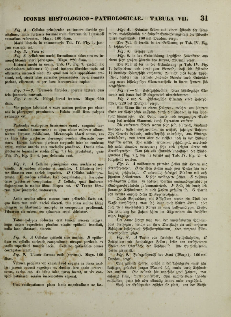Ftg, 4. Cellulae primigeniae ex tumore fibroide ge- nitalium, initia fortassis formandarum librarum in hujusmodi tumoribus referentes. JMagn. 160 diam. Morbi historia in commentario Tab. IV. Fig. 4. jam- jam enarrata est. Ftg. 5, Vasa et Fig. 6. cellularum nuclei formationem subeuntes ex tu- more} fibroide uteri permagno. Magn, 220 diam. Historia morbi in comm. Tab. IV. Fig. 7. exstat; hic conclusiones addamus: 1) quod tumores fibroides vasis sat efformatis instructi sint; 2) quod non sola appositione cre- scant, sed, sicuti telae normales permanentes, nova elementa pariant, elforment, et per haec incrementum capiant. Fig. 7—9. Tumores fibroides, quorum textura cum tela junctoria convenit. Fig. 7 et 8, Polypi fibrosi textura. Magn. 220 diam. Vir j)olypo laborabat e cavo narium postico per choa- nas in pharyngem prominente. Palato molli fisso polypus extractus est. Particulae exstirpatae firmissimae erant, sanguine tur- gentes, omnino homogeneae; et aqua elutae colorem album, textum fibrosum exhibebant. Microscopio edocti sumus, eas ex fibris telae junctoriae plerumque nondum efformatis con- stare. Harum fibrarum plurimae serpendo inter se confusae erant, multae nucleis cum nucleolis praeditae. Omnia telae junctoriae formandae stadia (Fig. 7.) hic prostabant, quae Tab. IV. Fig. 2—4. jam delineata sunt. Fig. 7. A Cellulae primigeniae cum nucleis et nu- cleolis. B eaedem diductae et caudatae. C Blastema levi- ter fibrosum cum nucleis impositis. D Cellulae valde pro- tensae. E eaedem cellulae, laxe coagminatae, in fasciculos - telae junctoriae complicatae. F Cellula, quae limborum disjunctione in multas fibras dilapsa est. G Textus fibra- rum telae junctoriae maturarum. Acido acetico affuso massae pars pellucida facta est, quo facto tum multi nuclei discreti, tum etiam multae fibrae integrae in blastemato amorpho in conspectum prodierunt. Fibrarum via orbem seu sphaeram sequi videbatur. Totus polypus obductus erat tunica mucosa integna, hujus autem superficies pluribus stratis epithelii tessellati, nullo loco vibratorii, obtecta. Fig. 8. A Cellulae epithelii sine nucleis. B epithe- lium ex cellulis nucleatis compositum; utraque particula ex variis superficiei tumoris locis. Cellulae epitheliales omnes corrugatae erant. Fig. 9. Tumor fibrosus cutis (verruca). Magn. 160 diam. Verruca jietiolata ex causa haud cognita in fossa axil- lari juvenis robusti vegetique ex duobus fere annis procre- scens, excisa est. Ab initio adeo parva fuerat, ut vix con- spici potuisset; sensim incrementum ceperat. Post exstirpationem plana lentis magnitudinem ac for- Fig. 4. ^rimare Selten auö einem ^ibroib ber @eni= talien, ma^rfdjeinlic^ bie früt;ejle ©ntroicfelungSftufe ber §ibroib= [afern barjlellenb, 160 mal £)urc^m. yergr. Ser galt- ijl bereite in ber ©rfldrung ju Tab. IV. Fig. 5. befd)rieben. Fig. .5. ©efdpc unb Fig. 6. in ber ßntmirfelung begriffene Sellenferne auö einem feljr gropen ^ibroib beg Uterug, 220 mal yergr. Ser galt ift ber in ber ©rlduterung ju Tab. IV. Fig. 7. befd)riebene unb bient jum S3emeife, bap bic gibroibc 1) beutli^e S3lutgefdpe entljalten, 2) nid)t blog burd) 2fppo= fition, fonbern mie normale bleibenbe ©emebe Durd) @ntmi(fe= lung neuer Ijifiologifdjer ©lementart(;eile in it;rem Snnern ftd) yergropern. Fig. 7 — 9. §afergefd)mutfte, beren l)iftologifc^e @le= mente mit benen beg 23inbegemebeg übereinfommen. Fig. 7 unb 8. »^ijlologifd;e (Sternente eineg ^aferpo- Ippen, 220 mal Surdjm. yergr. ©in 9)?ann litt an einem ^otppen, meld)er am l)interen ©nbe ber 9^afenl)6tjlc anfi^enb burd) bie ©l)oanen in ben ^l)a= rpnr l;ineinragte. Ser 5^oli)p mürbe nad) yorgdngiger @pal= tung beg meinen ©aumeng burd; Operation entfernt. Sie entfernten (Stuefe maren fel)r feft, blutrei(^, burd)aug l)omogen, l;atten auggemafc^en ein meipeg, faferigeg 2fnfel)en. Sl;i^ ©emebe befianb, mifroffopifd; unterfud)t, aug S3inbege= mebgfafern, yon benen aber bie meijlen no(^ in ber S3ilbung begriffen maren. Sie meifien erfdyienen gefd/ldngelt, unorbent= lid) unter einanber yermorren; fel;r yiele zeigten .^erne mit Äernfdrperdyen. 9}?an fa^ alle ©ntmicfelunggjlufen beg S3inbe= gemebeg (Fig. 1.), mie fte bereitg auf Tab. IV. Fig. 2—4. bargeftellt mürben. Fig. 7. A yollfommen primdre Sellen mit .fernen unb .^ernforperd)en. B biefelben Sellen nad) jmei ©eiten l)in yer= Idngert, gefd)mdn3t. C unbeutlid) faferigeg SSlajlem mit auf= fi^enben Sellenfernen. D fel)r yerldngerte Sellen. E biefelben yerldngerten Sellen, gu locferen Partien aneinanbergereil)t, ju 23inbegemebgbünbeln gufammentretenb. F Seile, bie burd) leU ftenartige 2lbfd)nurung in yiele ^afern verfallen ift. G Partie yon bereitg auggebilbeten S3inbegemebgfafern. Surd) Sel)anblung mit ©ffigfdure mürbe ein Sl)eil ber 5[l?affe burdf)fid)tig; man fa^ bann yiele ifolirte Äerne, aber aud) yiele unyerdnberte g^afern in einer l)alb=amorpbfn Staffe. Sie 9?id)tung ber g^afern fd)ien im 3fUgemeinen eine freigfor= mige, fugelige. Ser ganje Potpp mar yon ber unyerdnberten ©d)leim= l)aut über3ogen, metd)e an i^rer Sberfidd)e ein aug mel)reren ©d)id)ten beftel)enbeg ^flallerepitl)elium, aber nirgenbg g^lim= merepittyelium jeigte. Fig. 8. A Partie yon fernlofen ©pit^elialjetlen, B ©pitl)elium mit fernl;altigen Sellen; beibe yon uerfd^iebenen ©teilen ber Sberfldd;e ber ©efd)mulft. 2lUe ©pitbelialjellen maren gerunzelt. Fig. 9. gafergefd;mulft ber v^aut (SBarje), 160 mal Surd)m. yergr. ©ine geftieltc Sßarje, meld)e in ber Tfd^felgrube eineg fel;r frdftigen, gefunben jungen 9)?anneg fap, mürbe burd) 2Cbfd)nei= ben entfernt, ©ie beftanb feit ungefdl)r 3mei Seib^en, mar anfangg flein, faum bemerkbar, ot)ne nad)meigbare llrfad)c entftanben, l)atte ftd) aber allmdlig immer mel;r yergropert. 5Jtad) ber ©rftirpation erfd)ien fte platt, uon ber ©rope