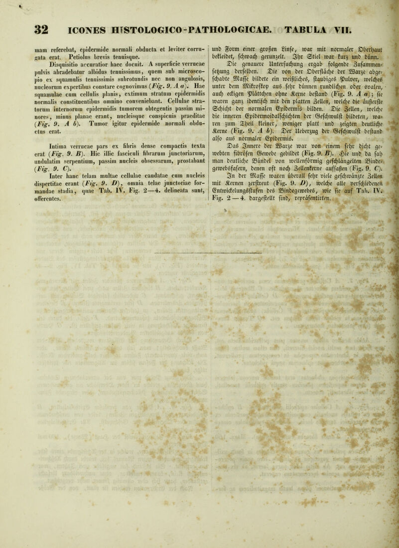 inain referebat, epidermide normali obducta et leiiter corru- gata erat. Petiolus brevis tenuisque. Disquisitio accuratior baec docuit. A superficie verrucae pulvis abradebatur albidas tenuissimus, quem sub microsco- pio ex squamulis tenuissimis subrotundis nec non angulosis, nucleorum expertibus constare cognovimus {Fig. 9. A «). Hae squamulae cum cellulis planis, extimum stratum epidermidis normalis constituentibus omnino conveniebant. Cellulae stra- torum internorum epidermidis tumorem obtegentis passim mi- nores, minus planae erant, nucleisque conspicuis praeditae {Fig. 9. A b). Tumor igitur ejiidermide normali obdu- ctus erat. Intima verrucae pars ex fibris dense compactis texta erat {Fig. 9. B). Hic illic fasciculi fibrarum junctoriarum, undulatim serjientium, passim nucleis obsessarum, prostabant {Fig. 9. C). Inter hanc telam multae cellulae caudatae cum nucleis dispertitae erant {Fig. 9. D), omnia telae jnnctoriac for- mandae stadia, quae Tab. IV. Fig. 2—4. delineata sunt, offerentes. unb §orm einer großen ßinfe, mar mit normaler Öberfiaut befleibet, f^ma(^ gerunjeft. ©tief war furj unb bünn. ®ie genauere Unterfud^ung ergab folgenbe 3ufammen= fe^ung berfelben. S)ie oon ber £)berfldd)e ber SBarje abge-- fefjabte 9)taffe bilbete ein weißlirf)eß, ftaubigeß ^uloer, weld)eö unter bem SÄifroffop auß fefjr bunnen runblicben ober oralen, aud) eefigen pdtteben ohne Äerne befianb (Fig. 9. A a)] fte waren ganj ibentijcb mit ben platten Sellen, welche Oie dußerjfe @^icbt ber normalen ©pibermiö bilben. 35ie Sellen, weldje bie inneren (?pibermoibalfcbicbten ber ©efcbwuljl: bilbeten, wa= ren jum Slb^‘^ Heiner, weniger platt unb jeigten beutlicbe .^erne (Fig. 9. A b). S)er Ueber5ug ber ©efcbwuljl: beffanb alfo aug normaler ßpibermig. ®aö innere ber Sßarje war ron einem febr bid}t ge^ webten fibrofen ©ewebe gebilbet (Fig. 9. B). ^ie unb ba fab man beutlicbe S3unbel ron wellenförmig gefcbldngelten ^inbe- gewebgfafern, benen oft noch SeUenferne auffapen (Fig. 9. C). Sn ber 5)taffe waren überall febr riele gefcbwdnjte Sellen mit fernen jerfireut (Fig. 9. I)), welcfie alle rerfd)iebenen ©ntwicfelunggffufen be§ SSinbegewebeö, wie fte auf Tab. IV. Fig. 2 — 4, bargejlellt finb, reprdfentirten.
