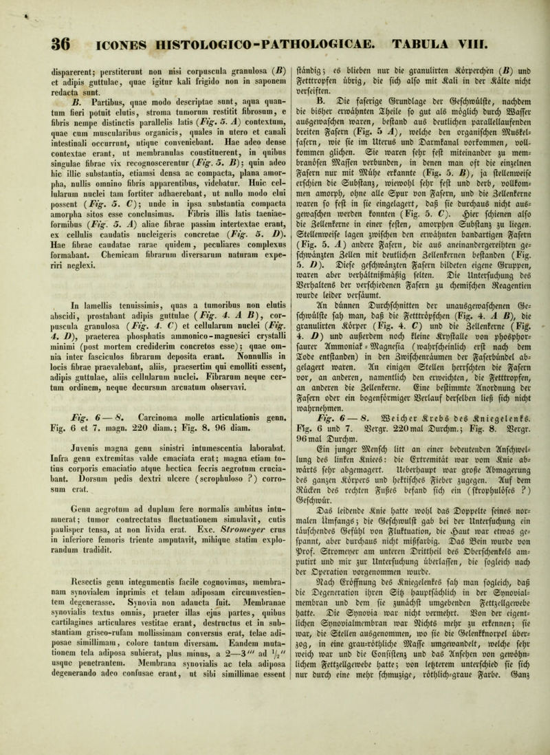 disparerent; perstiterunt non nisi corpuscula granulosa (B) et adipis guttulae, quae igitur kali frigido non in saponem redacta sunt. B. Partibus, quae modo descriptae sunt, aqua quan- tum fieri potuit elutis, stroma tumorum restitit fibrosum, e fibris nempe distinctis parallelis latis {Ftg, 5. A) contextum, quae cum muscularibus organicis, quales in utero et canali intestinali occurrunt, utique conveniebant. Hae adeo dense contextae erant, ut membranulas coustituerent, in quibus singulae fibrae vix recognoscerentur (Ftg. 5. B); quin adeo hic illic substantia, etiamsi densa ac compacta, plana amor- pha, nullis omnino fibris apparentibus, videbatur. Huic cel- lularum nuclei tam fortiter adhaerebant, ut nullo modo elui possent (Fig. 5. C); unde in ipsa substantia compacta amorpha sitos esse conclusimus. Fibris illis latis taeniae- formibus (Ftg. 5. A) aliae fibrae passim intertextae erant, ex cellulis caudatis nucleigeris concretae {Fig. 3. D). Hae fibrae caudatae rarae quidem, peculiares complexus formabant. Chemicam fibrarum diversarum naturam expe- riri neglexi. . In lamellis tenuissimis, quas a tumoribus non elutis abscidi, prostabant adipis guttulae {Fig. 4. A B), cor- puscula granulosa {Fig. 4. C) et cellularum nuclei {Fig. 4. D), praeterea phosphatis ammonico-magnesici crystalli minimi (post mortem crediderim concretos esse); quae om- nia inter fasciculos fibrarum deposita erant. Nonnullis in locis fibrae praevalebant, aliis, praesertim qui emolliti essent, adipis guttulae, aliis cellularum nuclei. Fibrarum neque cer- tum ordinem, neque decursum arcuatum observavi. Fig. 6 — 8, Carcinoma molle articulationis genn. Fig. 6 et 7. magn. 220 diam.; Fig. 8. 96 diam. Juvenis magna genu sinistri intumescentia laborabat. Infra genu extremitas valde emaciata erat; magna etiam to- tius corporis emaciatio atque hectica fecris aegrotum crucia- bant. Dorsum pedis dextri ulcere (scrophuloso ?) corro- sum erat. Genu aegrotum ad duplum fere normalis ambitus intu- muerat; tumor contrectatus fluctuationem simulavit, cutis paulisper tensa, at non livida erat. Exc. Stromei/er crus in inferiore femoris triente amputavit, mihique statim explo- randum tradidit. Resectis genu integumentis facile cognovimus, membra- nam synovialem inprimis et telam adiposam circumvestien- tem degenerasse. Synovia non adaucta fuit. Membranae synovialis textus omnis, praeter illas ejus partes, quibus cartilagines articulares vestitae erant, destructus et in sub- stantiam griseo-rufam mollissimam conversus erat, telae adi- posae simillimam, colore tantum diversam. Eandem muta- tionem tela adiposa subierat, plus minus, a 2—3' ad usque penetrantem. Membrana synovialis ac tela adiposa degenerando adeo confusae erant, ut sibi simillimae essent lldnbig; eö blieben nur bie gvanulirten .^6rperd)en {B) unb fetttropfen übrig, bie fid) alfo mit .^ali in ber Ädlte nid^t oerfeiften. B. S)ie faferige ©runblage ber ©efd^mdlfie, nad^bem bie bisher ermd^nten Steile fo gut alö möglich burd) Sßaffer auSgemafdyen waren, befianb auö beutlid)en parattellaufenben breiten fafern (Fig. 5 A), weld)c ben organifdjen 9Äu6tel= fafern, wie fte im Uteruö unb ©armtanal oorfommen, ooU- fommen glid)en. 0ie waren fe^r fejf miteinanber ju mem= branofen SJJaffen oerbunben, in benen man oft bie einzelnen fafern nur mit SJtü^e erfannte (Fig. 5. B), ja flellenweife erfd)ien bie ©ubfianj, wiewol)! fel;r feft unb berb, ooUfom= men amorph, ol)ne alle 0pur oon fafern, unb bie Sellenferne waren fo feft in fte eingelagert, bap fte burd)auö nid)t auö= gewafd)en werben fonnten (Fig. 5. C). .^ier fc^ienen alfo bie Sellenferne in einer feften, amorpljen ©ubfianj ju liegen. 0tellenweife lagen jwifdyen ben erwdljnten banbartigen fafern (Fig. 5. A) anbere fafern, bie auS aneinanbergereil)ten ge= fd)wdn5ten Sellen mit beutlid)en Sellenfernen befianben (Fig. 5. D). ^iefe gefdywdnjten fafern bilbeten eigene @ruppen, waren aber oerbdltnipmdpig feiten. 2)ie Unterfuc^ung bed SSerf)altenö ber oerfd)iebenen fafern ju djemif^en 9?eagentien würbe leiber oerfdumt. 21n bunnen S)ur^fd)nitten ber unau6gewafd)enen @e= fd)wulfle fa^ man, bap bie f etttropfd)en (Fig. 4. A B), bie granulirten Äorper (Fig. 4. C) unb bie Sellenferne (Fig. 4. D) unb auperbem noc^ fleine .^rpfialle oon p\)oBpi)OX= faurer 21mmoniaf = 50?agnefia (wal)rfd)einli(^ erjl nad) bem Sobe entfianben) in ben Swif(^enrdumen ber faferbünbel ab= gelagert waren. 3Cn einigen ©teilen ^errfd;ten bie fafern oor, an anberen, namentlich ben erwei(^ten, bie fetttropfen, an anberen bie Sellenferne. @ine bejiimmte Tlnorbnung ber fafern ober ein bogenförmiger SSerlauf berfelben liep fiel) nicht wahrnehmen. Fig. 6—8. 2öeid;er Ärebö beö .^niegelenfS. Fig. 6 unb 7. SSergr. 220 mal 2)urchm.; Fig. 8. SSergr. 96 mal S)ur(^m. @in junger 9)tenfdh litt an einer bebeutenben 3Cnfchwel= lung bed linfen .^nieeö: bie ©rtremitdt war oom Änie ab= wdrtö fehr abgemagert. Ueberhaupt war grope 21bmagerung be§ ganjen ÄorperS unb h^ftif^hc^ fieber jugegen. 3Cuf bem 9?ucfen beö rechten fitpeö befanb fid) ein (ffrophulofeö ?) ©efchwur. 2)aö leibenbe .^'nie l)atte wohl baö Stoppelte feineö nor= malen Ümfangö; bie ©efchwuljf gab bei ber Unterfuchung ein tdufchenbeS ©efühl »on fluftuafion, bie ,^aut war etwaä ge= fpannt, aber burd)auS nicht mipfarbig. ^Daö Sein würbe oon ^rof. ©tromeper am unteren £irittheil beö £>berfd)enfel§ am= putirt unb mir jur llnterfudjung uberlaffen, bie fogleid) nach ber Operation oorgenommen würbe. Sijad) Eröffnung be§ .^niegelenfeö fah man fogleid), bap bie Degeneration ihren ©i§ l)“wplf^4)^ich in ber ©pnooial= membran unb bem fte jundchft umgebenben fettjcllgewebe hatte. Die ©pnooia war nicht oermel)rt. Son ber eigent= liehen ©pnooialmcmbran war S'tichtö mehr ju erfennen; fte war, bie ©teilen ausgenommen, wo fie bie ©elenffnorpel uber= jog, in eine grau=rothliche 9)laffe umgewanbelt, welche fehr wei(^ war unb bie ßonfiflenj unb baö 31nfehen oon gew6hn= lichem fettjellgewebe 1)<iRp5 lenterem unterfchieb fte fid) nur burch eine mehr fchmujige, rothli<^=graue färbe, ©anj