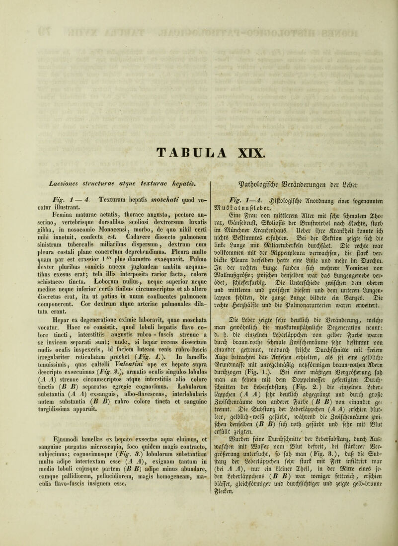 n- f-/ (,^', mM''- :f5< «»rJjlWiri^rt , ' ' oditi TABULA XIX. Laesiones structurae atque texturae hepatis, Fig. 1 — 4. Textarani hepatis moschati qnod vo- cator illustrant. Femina matarae aetatis, thorace angusto, pectore an- serino, vertebrisqne dorsalibus scoliosi dextrorsum laxatis gibba, in nosocomio Monacensi, morbo, de quo nihil certi inibi innotuit, confecta est. Cadavere dissecto pulmonem sinistrum tuberculis miliaribus dispersum, dextrum cum pleura costali plane concretam deprehendimus. Pleura multo quam par est crassior 1 plus diametro exaequavit. Pulmo dexter pluribus vomicis nucem juglandem ambitu aequan- tibus exesas cratj tela illis interposita rarior facta, colore scbistaceo tincta. Loborum nullas, neque superior neque medius neque inferior certis finibus circumscriptus et ab altero discretus erat, ita ut potias in unum confluentes pulmonem componerent. Cor dextram atque arteriae pulmonales dila- tata erant. Hepar ea degeneratione eximie laboravit, quae mosebata vocatur. Haec eo consistit, quod lobuli hepatis flavo co- lore tincti, interstitiis angustis rubro - fascis strenae a se invicem separati sunt; unde, si hepar recens dissectum nudis oculis inspexeris, id faciem lateam venis rubro-fuscis irregulariter reticulatam praebet (Fig. 1.). In lamellis tenuissimis, quas cultelli Valentini ope ex hepate supra descripto exsecuimus (Fig. 2.), armatis oculis singulos lobulos (A A) strenue circumscriptos atque interstitiis alio colore tinctis (B B) separatos egregie cognovimus. Lobulorum substantia (A A) exsanguis, albo-flavescens, interlobalaiis autem substantia (B B) rubro colore tincta et sanguine turgidissima apparuit. Fijusmodi lamellas ex hepate exsectas aqua eluimus, et sanguine purgatas microscopio, foco quidem magis contracto, subjecimus; cognovimnsque (Fig. 3.) lobulorum substantiam multo adipe intertextam esse (A A), exiguam tantum in medio lobuli cujusque partem (B B) adipe minus abundare, earaque pallidiorem, pellucidiorern, magis homogeneam, ma- culis llavo-fuscis insignem esse. pat^otogife^e S^erdnbecungen ber Seber J^ig> 1—4. t^iflologifdbe ^fnorbnung einer fogenannten atnupleber. @ine ^rau non mittlerem 2f(ter mit fe^r [carnalem £^0= rar, ©anfebruft, ©folioftö ber Srujtmirbet nad) Stetste, jtarb im 9)tundj)ner Äranfenbauä. lieber i^re .^ranf^eit fonnte id) nid)t§ 23e(limmteg erfahren. S3ei ber ©eftion jeigte ftd) bic tinfe Sunge mit 9)?iliartuberfeln burd)fdet. S!)ie red)te mar noflfommen mit ber £Uippenpleura nermai^fen, bie jlar! ner= biefte pleura berfelben b<^tte eine Sinie unb me^r im 3)urcbm. Sn ber rechten Sunge fanben \iö) mehrere Vomicae non SBaflnupgrope; smifd)cn benfelben mar bag flungengemebe ner= obet, febieferfarbig. 2)ie Unterf(^iebe jmifeben bem oberen unb mittleren unb jmifeb^*' biefem unb bem unteren ßungen= lappen fehlten, bie ganje flunge bilbete ein ©anjeg. ^ic redbte ^^erjbdlfte unb bic ^ulmonarartcrien maren ermeitert. 2)ic 2cber jeigte febr beutlid; bic S5erdnberung, mclcbe man gemobnlid) bie mugfatnupdbnli(^e SJegeneration nennt: b. b- einjelnen flebcrldppcben non gelber ^arbc maren burdb braun=rotbe fcbmalc 3»ifdbenrdume febr beftimmt non einanber getrennt, moburdb frif(^e ®ur(^f(^nitte mit freiem 3fuge betradbtet bag 2fnfeben erhielten, alg fei eine gelbliche ©runbmaffe mit unregelmdpig ne|f6rmigen braun=rotben 3fbern burchjogen (Fig. 1.). S3ei einer mdpigen SSergroperung fab man an feinen mit bem 2)oppelmeffcr gefertigten ^Durd;= fdbnitten ber Seberfubftanj (Fig. 2.) bie einzelnen 2eber= Idppcben (A A) febr beutlicb abgegrdnjt unb bureb grope 3mifdbenrdumc non anberer ^arbe (B B) non einanber ge= trennt. S)ie (Subjlan^ ber ßeberldppcbcn (A A) erfebien blut= leer, gelblich = meip «^dbrenb bic 3mifdbenrdume jmi- feben benfelben (B B) fi(^ rotb gefdrbt unb febr mit 58lut erfüllt geigten. Sßurben feine S)urdbfcbnitte ber Seberfubflanä, bureb • mafdben mit 2Baffer nom S3lut befreit, bei fidrferer SSer= groperung unterfuebt, fo fab man (Fig. 3.), bap bic (Sub= fianj ber Seberldppcben fei)r fiarf mit §ett infiltrirt mar (bei A A), nur ein fleincr SXb^i^ 9)Iitte eineg je^ ben 2eberldppd)eng (B B) mar meniger fettreidb, erfebien bldffer, gleichförmiger unb burebfiebtiger unb geigte gelb-braune ^lc(fen.