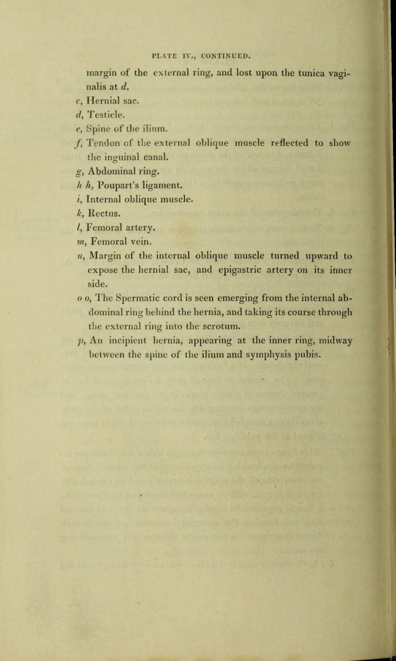 PLATE IV., CONTINUED. margin of the external ring, and lost upon the tunica vagi- nalis at d. c, Hernial sac. d, Testicle. e, Spine of the ilium. f, Tendon of the external oblique muscle reflected to show the inguinal canal. g, Abdominal ring. h h, Poupart’s ligament. i, Internal oblique muscle. k, Iiectus. l, Femoral artery. vi, Femoral vein. v, Margin of the internal oblique muscle turned upward to expose the hernial sac, and epigastric artery on its inner side. o o, The Spermatic cord is seen emerging from the internal ab- dominal ring behind the hernia, and taking its course through the external ring into the scrotum. p, An incipient hernia, appearing at the inner ring, midway between the spine of the ilium and symphysis pubis.