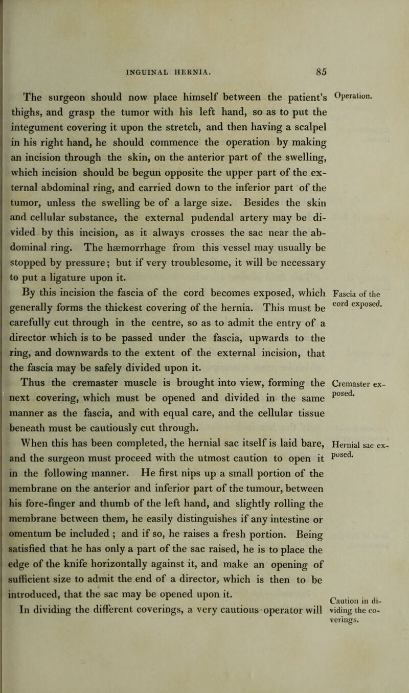 The surgeon should now place himself between the patient’s thighs, and grasp the tumor with his left hand, so as to put the integument covering it upon the stretch, and then having a scalpel in his right hand, he should commence the operation by making an incision through the skin, on the anterior part of the swelling, which incision should be begun opposite the upper part of the ex- ternal abdominal ring, and carried down to the inferior part of the tumor, unless the swelling be of a large size. Besides the skin and cellular substance, the external pudendal artery may be di- vided by this incision, as it always crosses the sac near the ab- dominal ring. The haemorrhage from this vessel may usually be stopped by pressure; but if very troublesome, it will be necessary to put a ligature upon it. By this incision the fascia of the cord becomes exposed, which generally forms the thickest covering of the hernia. This must be carefully cut through in the centre, so as to admit the entry of a director which is to be passed under the fascia, upwards to the ring, and downwards to the extent of the external incision, that the fascia may be safely divided upon it. Thus the cremaster muscle is brought into view, forming the next covering, which must be opened and divided in the same manner as the fascia, and with equal care, and the cellular tissue beneath must be cautiously cut through. When this has been completed, the hernial sac itself is laid bare, and the surgeon must proceed with the utmost caution to open it in the following manner. He first nips up a small portion of the membrane on the anterior and inferior part of the tumour, between his fore-finger and thumb of the left hand, and slightly rolling the membrane between them, he easily distinguishes if any intestine or omentum be included ; and if so, he raises a fresh portion. Being i satisfied that he has only a part of the sac raised, he is to place the 1 edge of the knife horizontally against it, and make an opening of sufficient size to admit the end of a director, which is then to be / introduced, that the sac may be opened upon it. In dividing the different coverings, a very cautious operator will Operation. Fascia of the cord exposed. Cremaster ex- posed. Hernial sac ex- posed. Caution in di- viding the co- verings.