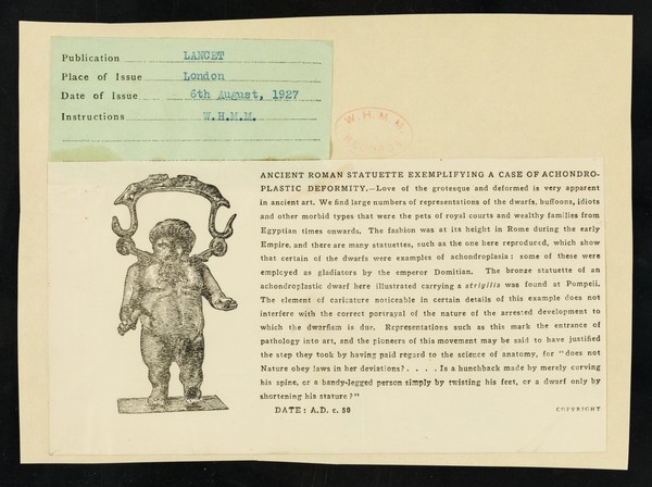 [Cutting from the Lancet for 6 August 1927 showing an "Ancient Roman statuette exemplifying a case of achondroplastic deformity"].