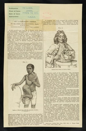 [Cutting from The Lancet of 7 January 1928 proposing surgery in cases of conjoined twins, James Poro and Laloo are shown].