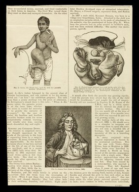 [Cutting from the Britsh medical journal: "A lecture on the psychology of conjoined twins: a study of monsterhood". Daisy and Violet Hilton are shown].