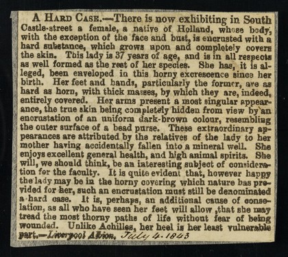 A hard case : there is now exhibiting in South Castle-street a female, a native of Holland, whose body, with the exception of the face and bust, is encrusted with a hard substance, which grows upon and completely covers the skin. This lady is 37 years of age ... Liverpool Albion.