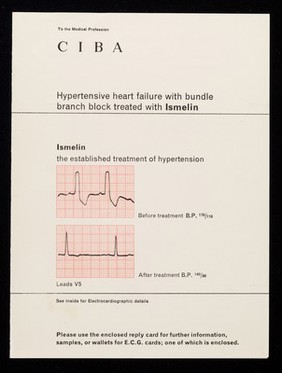 Hypertensive heart failure with bundle branch block treated with Ismelin.