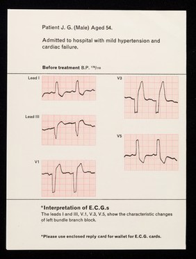 Hypertensive heart failure with bundle branch block treated with Ismelin.