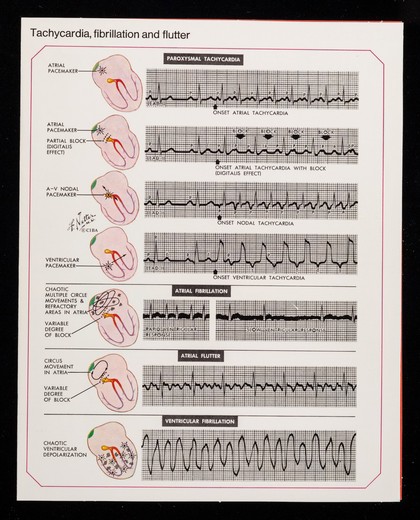 Arrhythmias and hypokalaemia : results of a recent Norwegian study ...