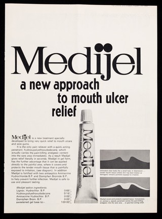 Medijel : a new approach to mouth ulcer relief.