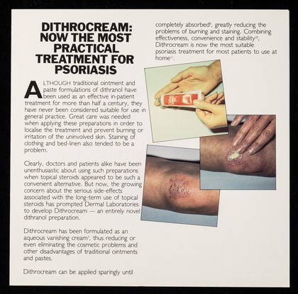 How to prevent rebound psoriasis : Dithrocream: now the most practical treatment for psoriasis.