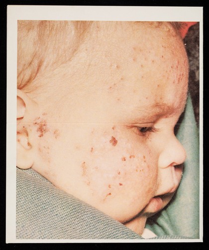 Betnovate : anti-infective preparations : classic answers to infected dermatoses.