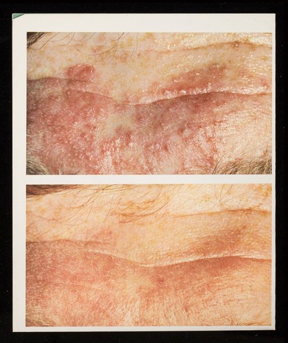 Betnovate : Betnovate-N and Betnovate-C creams : classic answers to moist infected dermatoses.