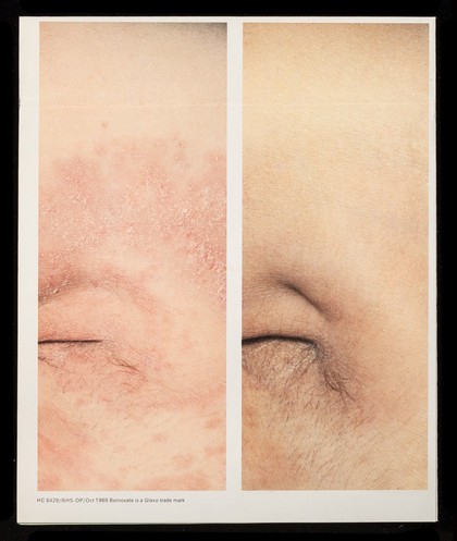 Betnovate : Betnovate-N and Betnovate-C creams : classic answers to moist infected dermatoses.