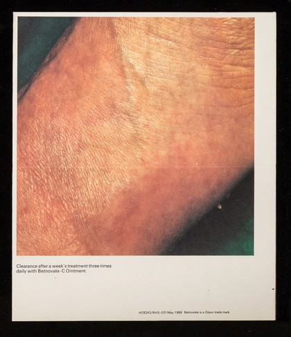 Betnovate : Betnovate-N and Betnovate-C ointments : classic answers to dry infected dermatoses.