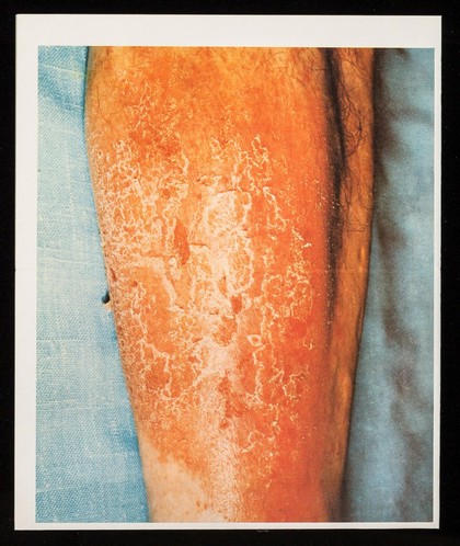 Betnovate cream : the classic answer to moist, weeping dermatoses.