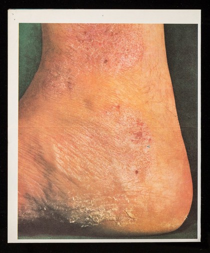 Betnovate ointment : the classic answer to dry, scaling dermatoses.