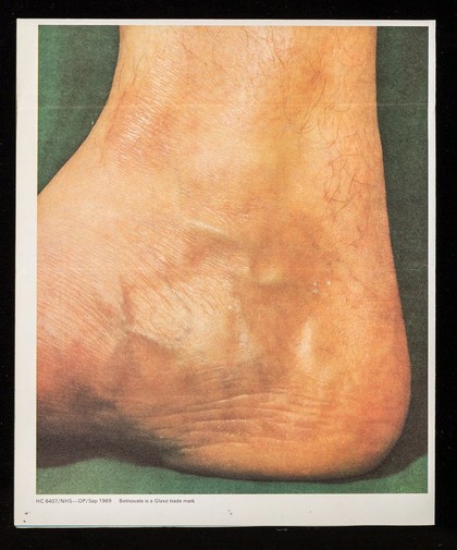 Betnovate ointment : the classic answer to dry, scaling dermatoses.