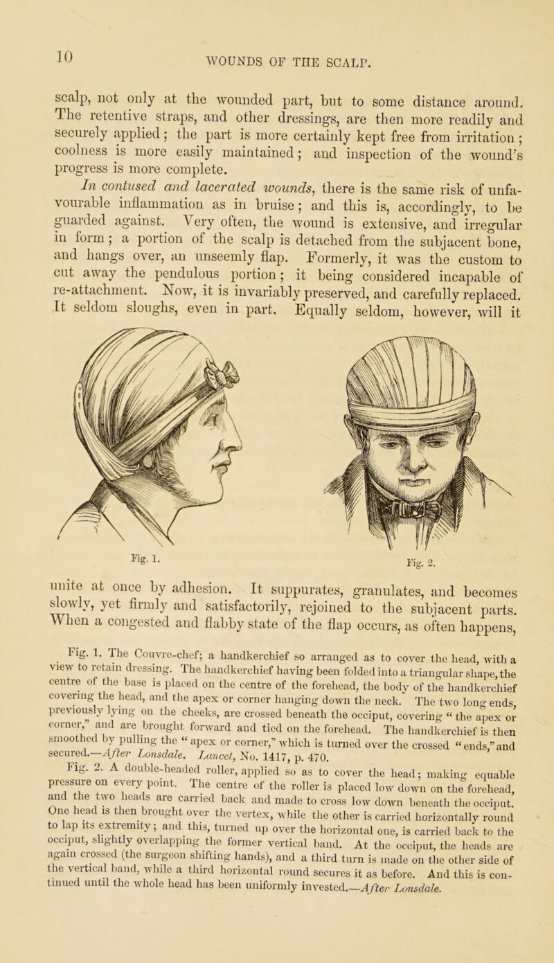 scalp, not only at the wounded part, hut to some distance around. The retentive straps, and other dressings, are then more readily and securely applied | the part is more certainly kept free from irritation ; coolness is more easily maintained; and inspection of the wound’s progress is more complete. In contused and lacerated wounds, there is the same risk of unfa- vourable inflammation as in bruise | and this is, accordingly, to be guarded against. Very often, the wound is extensive, and irregular in form; a portion of the scalp is detached from the subjacent bone, and hangs over, an unseemly flap. Formerly, it was the custom to cut away the pendulous portion; it being considered incapable of 1 e-attachment. Now, it is invariably preserved, and carefully replaced. It seldom sloughs, even in part. Equally seldom, however, will it unite at once by adhesion. It suppurates, granulates, and becomes slowly, yet firmly and satisfactorily, rejoined to the subjacent parts. When a congested and flabby state of the flap occurs, as often happens. Hg. 1. The Couvre-chef; a handkerchief so arranged as to cover the head, Avdth a view to retain dressing. The handkerchief having been folded into a triangular shape, the centre of the base is placed on the centre of the forehead, the body of the handkerchief covering the head, and the apex or corner hanging down the neck. The tivo long ends previously lying on the cheeks, are crossed beneath the occiput, covering “ the apex or corneiV and are brought forward and tied on the forehead. The handkerchief is then smoothed by pulling the “apex or corner,” which is turned over the crossed “ends,”and secured.—A/ter Lonsdale. lAincet, No. 1417, p. 470. Fig. 2. A doubleAieaded roller, applied so as to cover the head; making equable pressm-e on every point. The centre of the roller is placed low down on the forehead, and the two heads are carried back and made to cross low down beneath the occiput. One head is then brought over tlie vertex, while the other is carried horizontally round to lap Its extremity; and this, turned up over the horizontal one, is carried back to the occiput, slightly overlapping the former vertical band. At the occiput, the heads are again crossed (the siirgeon shifting hands), and a third turn is made on the other side of the vertical band, while a third horizontal round secures it as before. And this is con- tinued until the whole head has been uniformly invested.—A/tei- Lonsdale.