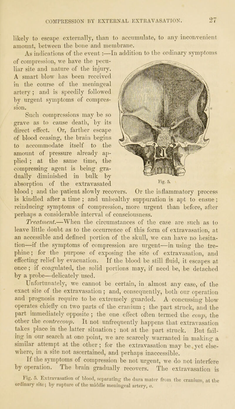 likely to escape externally, than to accnmnlate, to any inconvenient amonnt, between the bone and membrane. As indications of the event ;—In addition to the ordinary symptoms of compression, we have the pecu- liar site and nature of the injury. A smart blow' has been received in the course of the meningeal artery ; and is speedily followed by urgent symptoms of compres- sion. Such compressions may be so grave as to cause death, by its direct effect. Or, farther escape of blood ceasing, the brain begins to accommodate itself to the amonnt of pressure already ap- plied ; at the same time, the compressing agent is being gra- dually diminished in bulk by absorption of the extravasated blood ; and the patient slowly recovers, is kindled after a time ; and unhealthy suppuration is apt to ensue ; reinducing symptoms of compression, more urgent than before, after perhaps a considerable interval of consciousness. Treatment.—When the circumstances of the case are such as to leave little doubt as to the occurrence of this form of extravasation, at an accessible and defined portion of the skull, w'e can have no hesita- tion—if the symptoms of compression are urgent—in using the tre- phine ; for the purpose of exposing the site of extravasation, and effecting relief by evacuation. If the blood be still fluid, it escapes at once ; if coagulated, the solid portions may, if need be, be detached by a probe—delicately used. Tig. 5. Or the inflammatory process Unfortunately, we cannot be certain, in almost any case, of the exact site of the extravasation; and, consequently, both our operation and prognosis require to be extremely guarded. A concussing blow operates chiefly on twm parts of the cranium ; the part struck, and the part immediately opposite ; the one effect often termed the coiqi, the other the contrecoup. It not unfrequently happens that extravasation takes place in the latter situation ; not at the part struck. But fail- ing in our search at one point, we are scarcely warranted in making a similar attempt at the other ; for the extravasation may be yet else- where, in a site not ascertained, and perhaps inaccessible. If the symptoms of compression be not urgent, w’e do not interfere by operation. The brain gradually recovers. The extravasation is tig. 5. Extravasation of blood, separating the dura mater from the craninm, at the ordinary' site; by rupture of the middle meningeal artery, a.