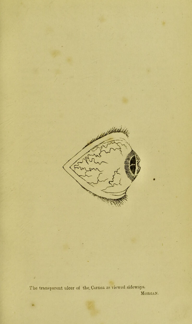 The transparent ulcer of the. Cornea as viewed sideways. Morgan.