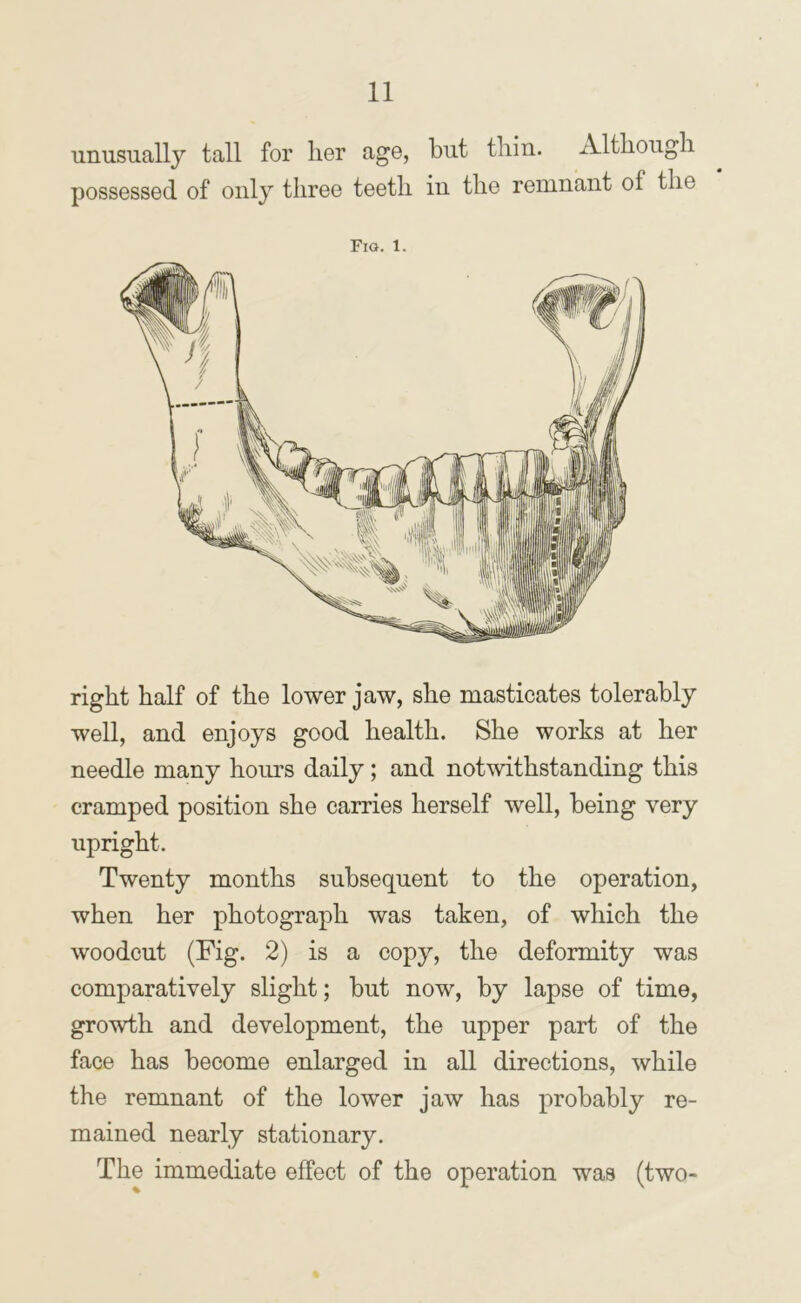 unusually tall for her age, but thin. Although possessed of only three teeth in the remnant of the Fig. 1. right half of the lower jaw, she masticates tolerably well, and enjoys good health. She works at her needle many hours daily; and notwithstanding this cramped position she carries herself well, being very upright. Twenty months subsequent to the operation, when her photograph was taken, of which the woodcut (Fig. 2) is a copy, the deformity was comparatively slight; but now, by lapse of time, growth and development, the upper part of the face has become enlarged in all directions, while the remnant of the lower jaw has probably re- mained nearly stationary. The immediate effect of the operation was (two-