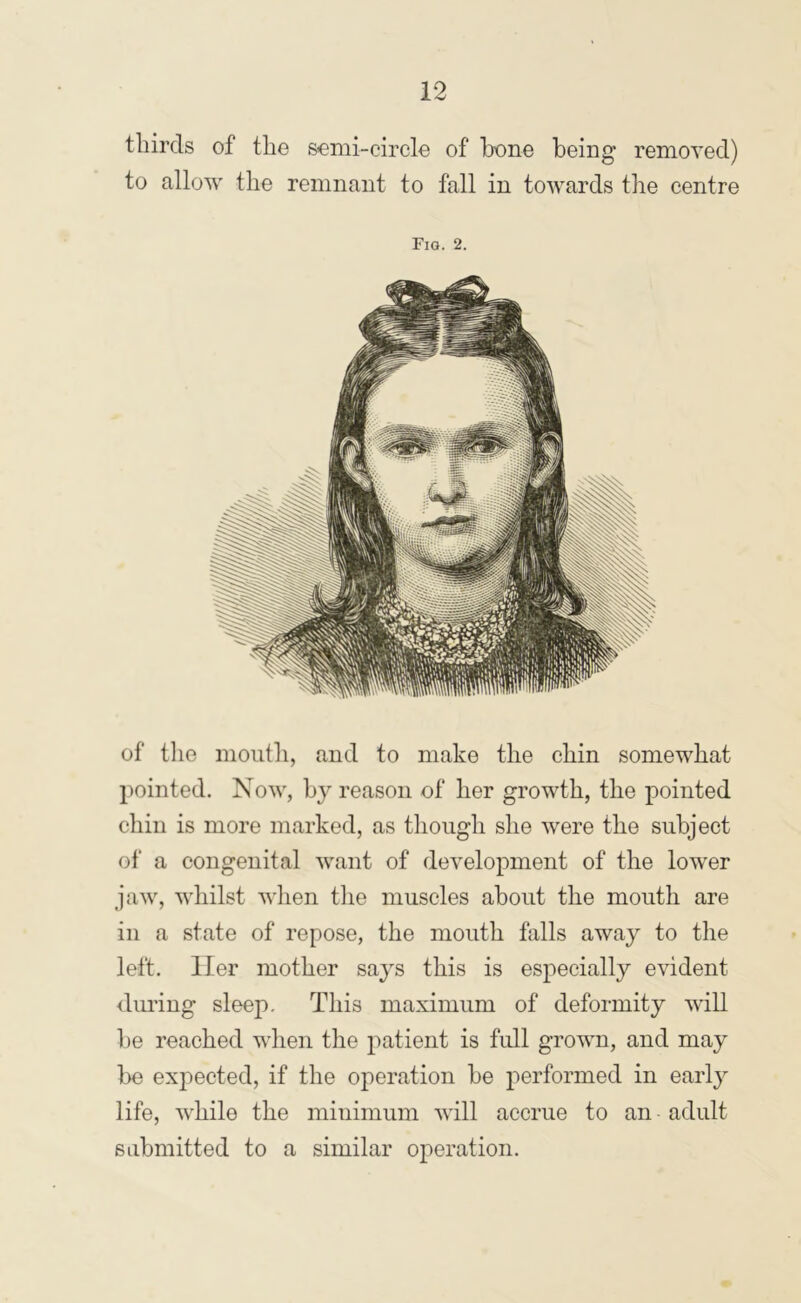 thirds of the semi-circle of hone being removed) to allow the remnant to fall in towards the centre Fig. 2. of tlie mouth, and to make the chin somewhat pointed. Now, by reason of her growth, the pointed chin is more marked, as though she were the subject of a congenital want of development of the lower jaw, whilst when the muscles about the mouth are ill a state of repose, the mouth falls away to the left. Her mother says this is especially evident (luring sleep. This maximum of deformity will be reached when the patient is full grown, and may be expected, if the operation be performed in early life, while the minimum will accrue to an adult submitted to a similar operation.