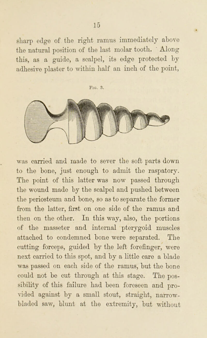 sharp edge of the right ramus immediately above the natural position of the last molar tooth. Along this, as a guide, a scalpel, its edge protected by adhesive plaster to within half an inch of the point, Fig. 3. was carried and made to sever the soft parts down to the bone, just enough to admit the raspatory. The point of this latter was now passed through the wound made by the scalpel and pushed between the periosteum and bone, so as to separate the former from the latter, first on one side of the ramus and then on the other. In this way, also, the portions of the masseter and internal pterygoid muscles attached to condemned bone were separated. The cutting forceps, guided by the left forefinger, were next carried to this spot, and by a little care a blade was passed on each side of the ramus, but the bone could not be cut through at this stage. The pos- sibihty of this failure had been foreseen and pro- vided against by a small stout, straight, narrow- bladed saw, blunt at the extremity, but without