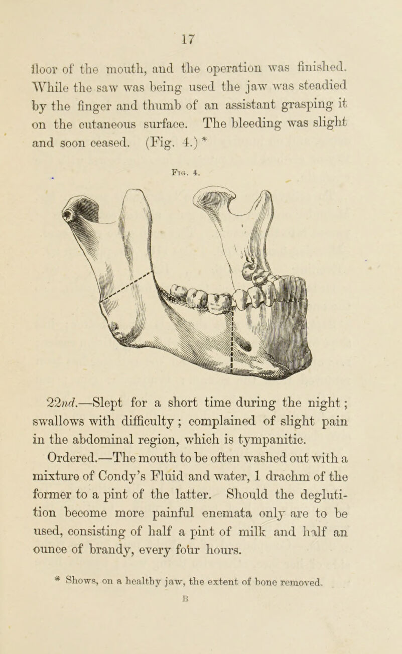 lloor of the mouth, and the operation was finislied. While the saw' w'as being used the jaw 'was steadied by the finger and thumb of an assistant grasping it on the cutaneous surface. The bleeding was slight and soon ceased. (I'hg. f.) * Fh5. 4. 22nd.—Slept for a short time during the night; sw^allow^s wdth difficulty ; complained of slight pain in the abdominal region, which is tympanitic. Ordered.—The mouth to be often washed out with a mixture of Condy’s Fluid and water, 1 drachm of the former to a pint of the latter. Should the degluti- tion become more painful enemata only are to be used, consisting of half a pint of milk and half an ounce of brandy, every fohr hours. * Shows, on a healthy jaw', the extent of hone removed. R