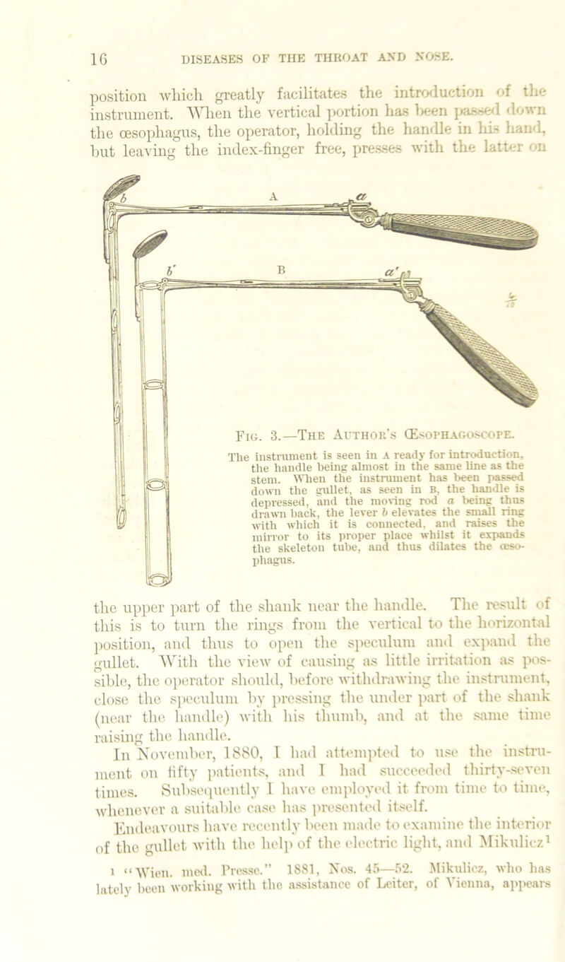 position wliicli greatly facilitates the introduction of tlie instrument. AMien the vertical portion has been jiasse^l down the oesophagus, the operator, liolding the handle in Ills liand, but leaving the index-finger free, presses with the latter on Fig. 3.—The Author’s (Esophago.scope. The iiistniment is seen in a ready for introduction, the handle being almost in the same line as the stem. When the instrument has l>een passed dowm the gullet, as seen in B, the handle is depressed, and the monng rod a Iwing thus droAvn hack, the lever 6 elevates the small ring with whieh it is connected, and raises the mirror to its proper place whilst it expands the skeleton tube, and thus dilates the oeso- Xdiagus. the upper part of the shank near the handle. The restxlt of this is to turn the rings from the vertical to the horizontal position, and thus to open the speculum and expand the gullet. AVith the view of causing as little irritation as pos- sible, the operator should, before withdrawing the instrument, close the speculum by }U'essing the under ]iart of the shank (near the handle) with his tiuimb, and at the .same time raismg the handle. In November, 1880, 1 had attumiited to u.<e the in.stru- ment on Hfty patients, and T had succeeded thirty-seven times. Subsequently I have employed it from time to time, whenever a suitable case has presented itself. Kndeavours have recently been made to examine the interior of the gullet with the help of the electric light, and Mikulicz^ 1 “tVien. mod. Presse.” 1881, Xos. 4.5—.52. Mikulicz, wlio has lately been working with the assistance of Loiter, of Vienna, appears