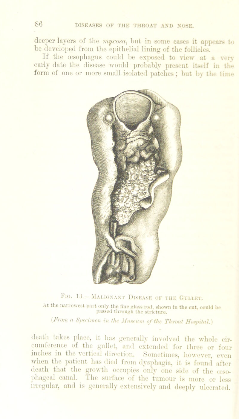 deeper layers of tlio mymxa, Imt in s^nne cases it ajjjs.'ars to be develojied from tlie epithelial lining of the follicles. If the (esophagus could he exp(js(;d to view at a very early date the disease would ju-ohahly jtre.sent itst-lf in the form of one or more small is(jlated patches; hut hy the time 1'm. IS.—.Mauknant Diskask of the Gvi.i.et. At tile iiaiTowest aiirt only the line jtlass nui. shown in the cut, could be passed Ihroujih the stricture. {J^ioiii If Sfu't'niU'ii ill tht' Miist'ii/ii of the Thront Ifttsjiihi?.) death takes jilaci', it ha.s generally IuvoIvcmI the whole eir- eumfereuee of the giillet, and e.xtended for three or four inehi's in the vertical direction. Sometime.s, howeviu'. even when the jiatieiit has died from dysjihagia, it is found after death that the growth oeeu]iies only one side of the lestv phageal canal. The surface of the tumour is more or less irregular, and is generally ('xteiisively and deeidy ulcerated.