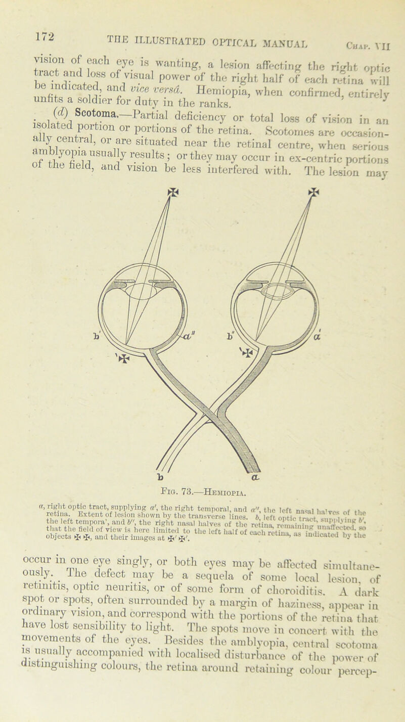 vision of each eye is wanting, a lesion affecting the right optic t^act anil bss of visual power of the right half of each retina will be indicated, and vice versd. Hemiopia, when confirmed, entirely unhts a soldier for duty in the ranks. 3 (d) Scotoma. Partial deficiency or total loss of vision in an isolated portion or portions of the retina. Scotomes are occasion- al •’ 0rnre Slfcuated near the retinal centre, when serious amblyopia usually results ; or they may occur in ex-centric portions ot the field, and vision be less interfered with. The lesion mar Fig. 73.—Hemiopia. «, right optic tract, supplying a', the right temporal and a the left , , obJeVte* the 1Cft Ua!f °f retina, occur m one eye singly, or both eyes may be affected simultane- ously. J fie defect may be a sequela of some local lesion of retinitis, optic neuritis, or of some form of choroiditis. A dark spot or spots, often surrounded by a margin of haziness, appear in ordinary vision, and correspond with the portions of the retina that have lost sensibility to light. The spots move in concert with the movements of the eyes. Besides the amblyopia, central scotoma is usually accompanied with localised disturbance of the power of distinguishing colours, the retina around retaining colour percep-