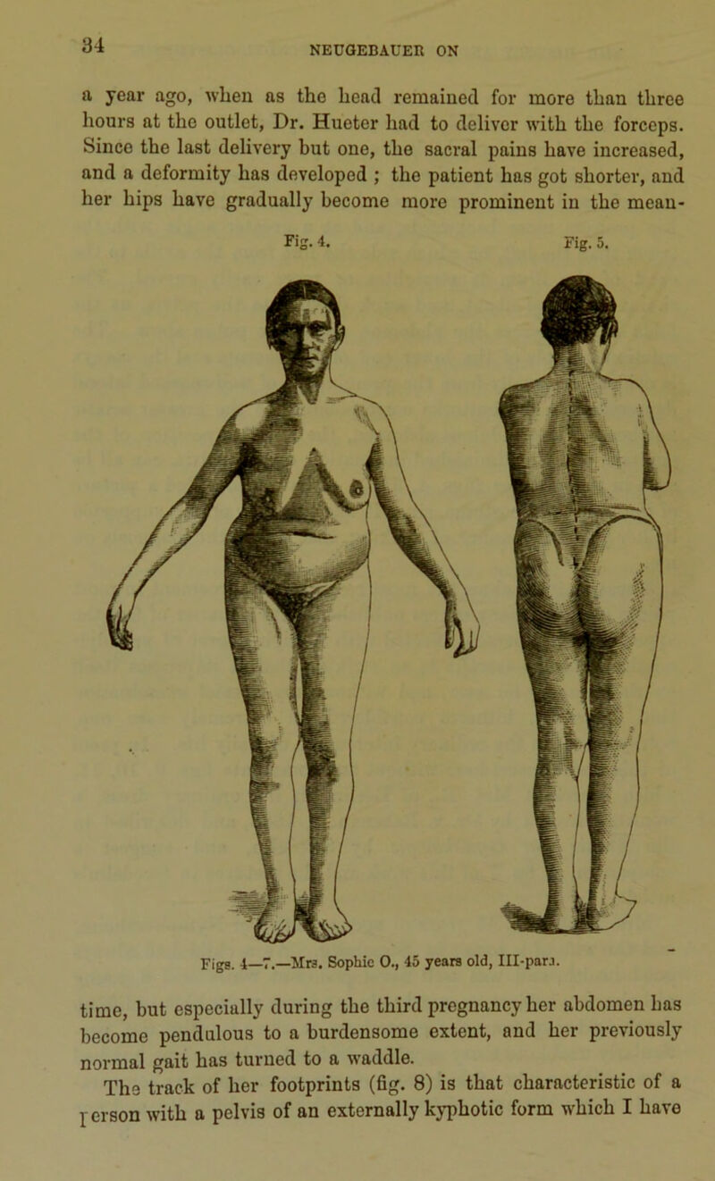 a year ago, when as tho beat! remained for more tban tbrce hours at thc outlet, Dr. Hueter bail to deliver witb tlic forceps. Since tbe last delivery but one, tbe sacral pains bave increased, and a deformity bas developod ; tbe patient bas got shorter, and ber bips bave gradually become more prominent in tbe mean- Fig. 4. Fig. 5. Figs. 4—7.—Mrs. Sophie O., 45 years old, 111-par.i. time, but especially during tbe tbird pregnancy ber abdomen bas become pendulous to a burdensome extent, and ber previously normal gait bas turned to a waddle. The tract of ber footprints (fig. 8) is tbat cbaracteristic of a 1 erson witb a pclvis of an externally kyphotic form wbicb I bave