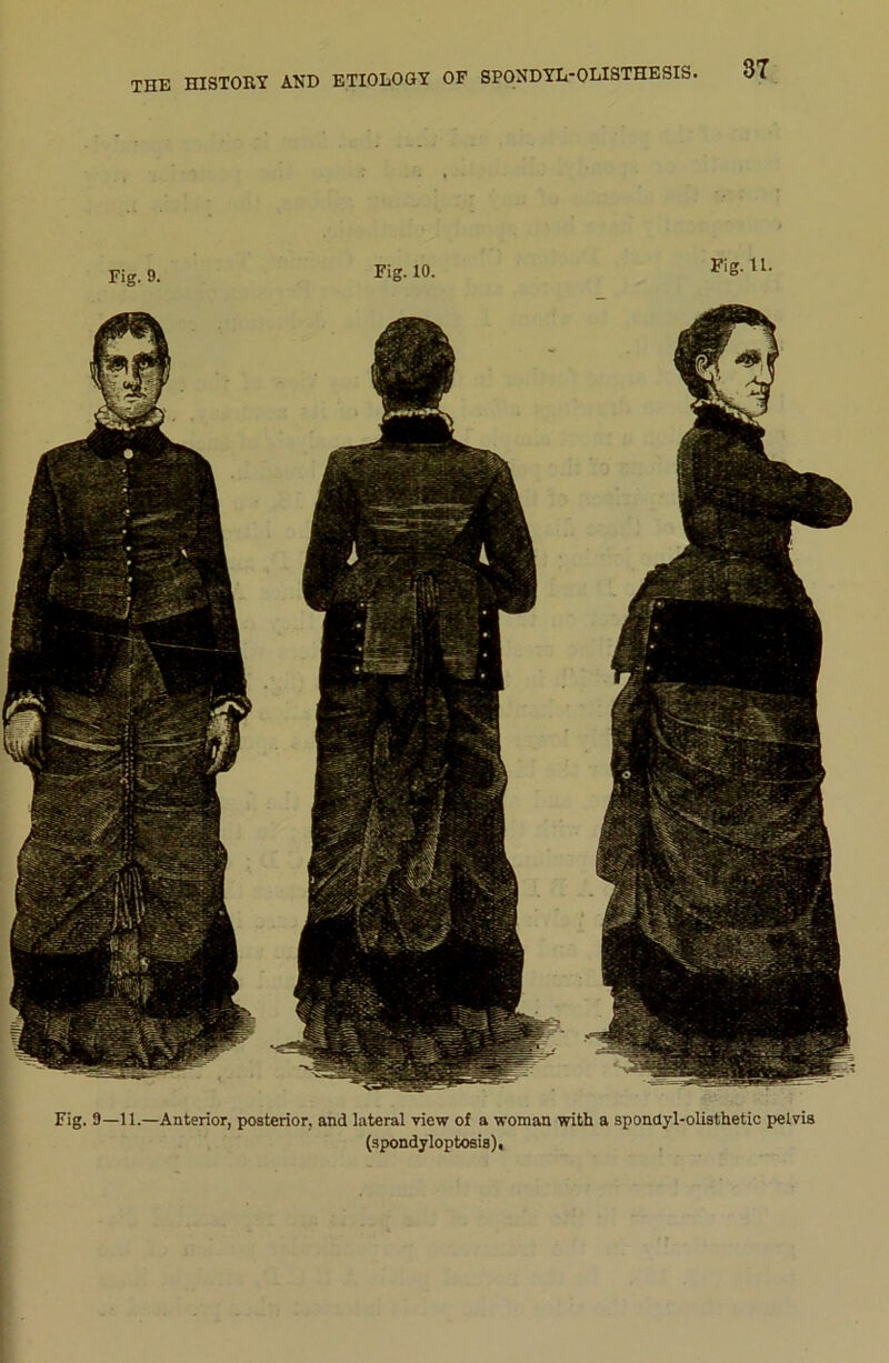 THE HISTORY AND ETIOLOGY OF Fig. 9. Fig. 10. Fig. U. Fig. 9—11.—Anterior, posterior, and latéral view of a woman with a sponüyl-olisthetic pelvia (spondyloptosis).