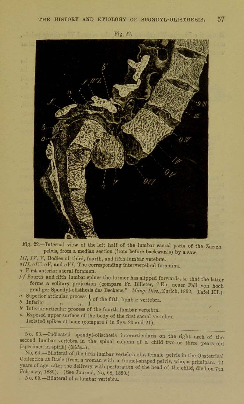 Fig. 22. Fig. 22.—Internai view of the left half of the lumbar sacral parta of the Zurich pelvis, from a médian section (from before backwards) by a saw. III, IV, V, Bodies of third, fourth, and fifth lumbar vetebræ. oIII, oIV, oV, and oVI, The corresponding intervertébral foramina. o First anterior sacral foramen. ff Fourth and fifth lumbar spines the former has slipped forwards, so that the latter forms a solitary projection (compare Fr. Billeter, “Ein neuer Fall von hoch gradiger Spondyl-olisthesis des Beckens.” Mang. Diss., Zurich, 1862. Tafel III.). a Superior artieular process 1 , b Inferior „ „ j of the fifth lumbar vertebra. b' Inferior articulai- process of the fourth lumbar vertebra. n Exposed upper surface of the body of the first sacral vertebra. Isolated spikes of bone (compare i in figs. 20 and 21). No. 63. Indicated spondyl-olisthesis interarticularis on the right arch of the second lumbar vertebra in the spinal column of a child two or three years old [specimen in spirit] {ibidem). No. 61.—Bilateral of the fifth lumbar vertebra of a female pelvis in the Obstétrical Collection at Basic (from a woman with a funnel-shaped pelvis, who, a primipara 4-> years of âge, after the delivery with perforation of the head of the child, died on 7th February, 1880). (See Journal, No. G8, 1880.) No. 65.—Bilateral of a lumbar vertebra.