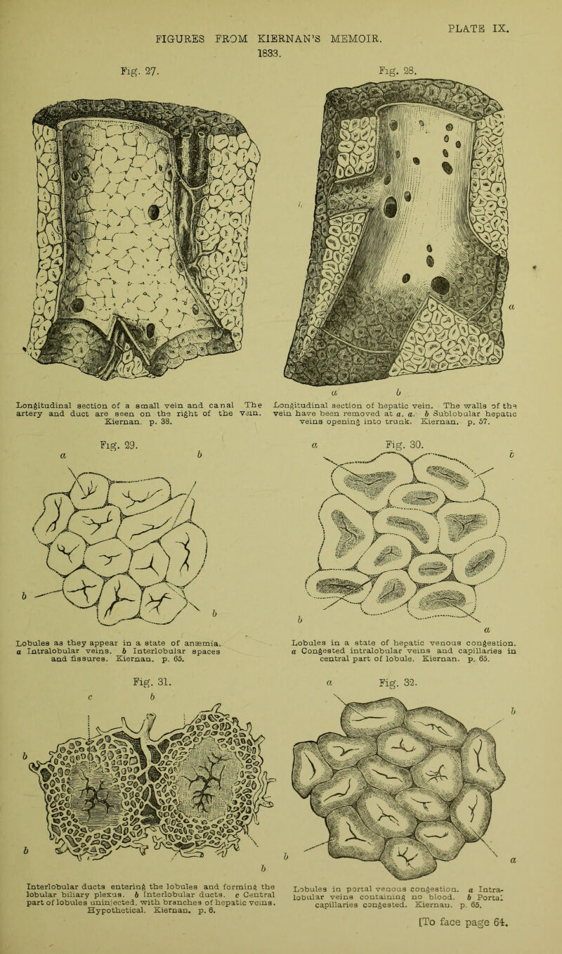 FIGURES FROM KIERNAN’S MEMOIR. 1833. PLATE IX. Fig. 27. Longitudinal section of a small vein and canal .The artery and duct are seen on the right of the vein. Kiernan. p. 38. Fig. 29. a b Lobules as they appear in a state of anaemia. a Intralobular veins, b Interlobular spaces and fissures. Kiernan, p. 65. Fig. 28. a b Longitudinal section of hepatic vein. The walls of the have been removed at a, a. b Sublobular hepatic veins opening into trunk. Kiernan. p. 57. a Fig. 30. Lobules in a state of hepatic venous congestion. a Congested intralobular veins and capillaries in central part of lobule. Kiernan. p. 65. Fig. 31. a Fig. 32. c b b Interlobular ducts entering the lobules and forming the lobular biliary plexus, b [nterlobular ducts, c Central part of lobules uninjected, with branches of hepatic veins. Hypothetical. Kiernan. p. 6. Lobules in portal venous congestion, a Intra- lobular veins containing no blood. 6 Portal capillaries congested. Kiernau. p. 65. b a [To face page 64.