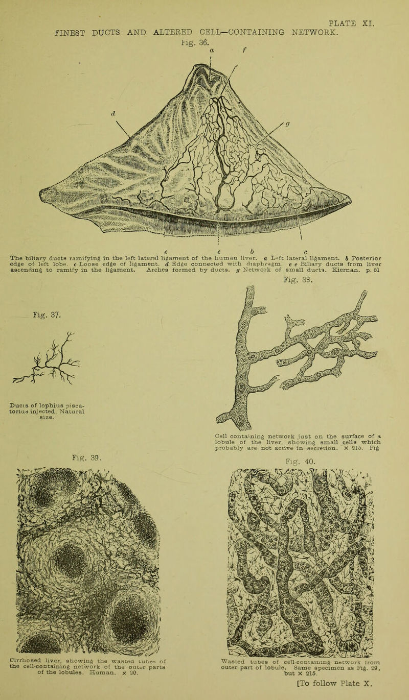 .FINEST DUCTS AND ALTERED CELL—CONTAINING NETWORK. Mg. 36. e e b c The biliary ducts ramifying in the left lateral ligament of the human liver, a Left lateral ligament, b Posterior edge of- left lobe, c Loose edge of ligament- d Edge connected with diaphragm, e e Biliary ducts from liver ascending to ramify in the ligament. Arches formed by ducts, g Network of small ducts. Kiernan. p. 61 Cirrhosed liver, showing the wasted tubes of the cell-containing network of the outer parts of the lobules. Human, x 20. Eig. 33. Cell containing network just on the surface of a lobule of the liver, showing small cells which probably are not active in secretion. X 215. Pig Fig. 40. Wasted tubes of cell-containing network from outer part of lobule. Same specimen as Eig. 29, but X 215.