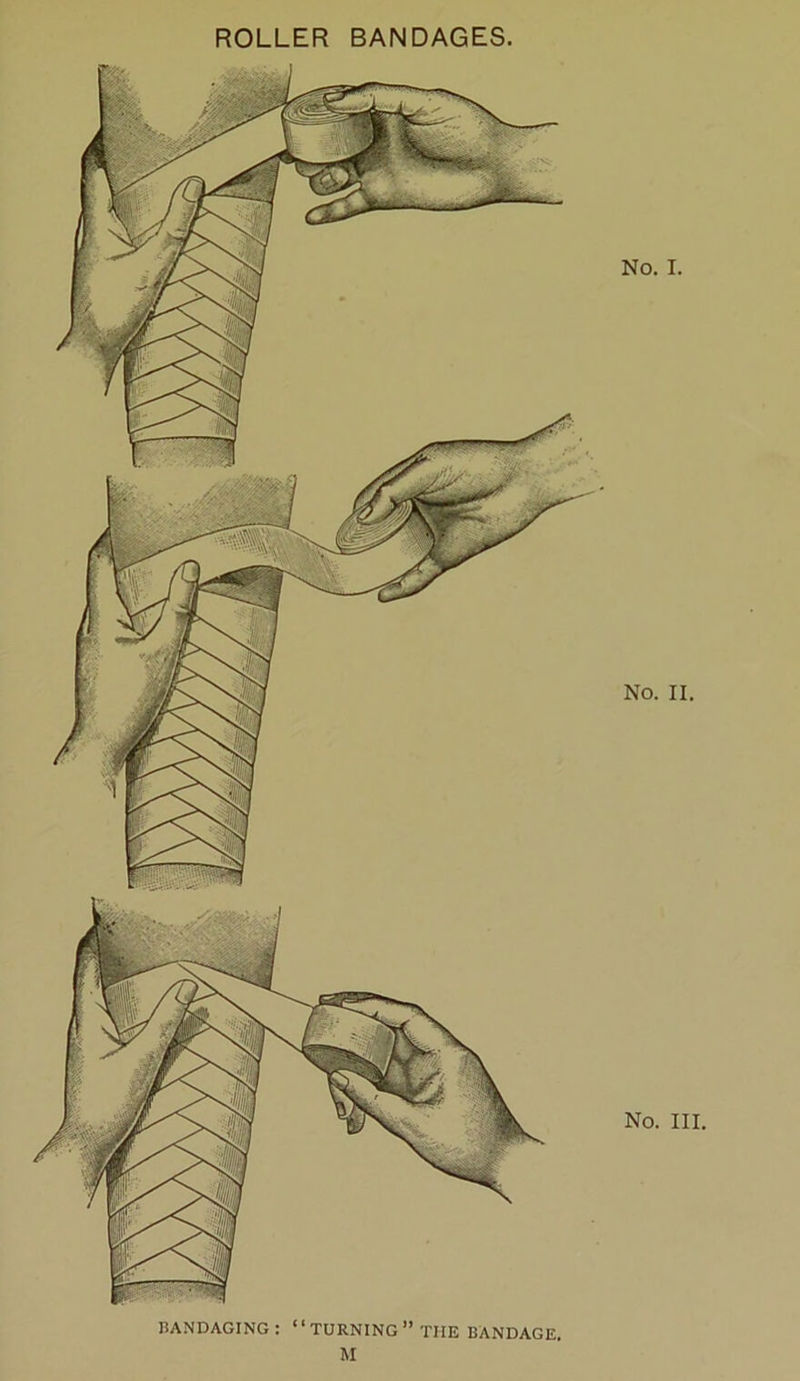 No. I. No. II. No. III. BANDAGING : ‘ ‘ TURNING ” THE BANDAGE. M