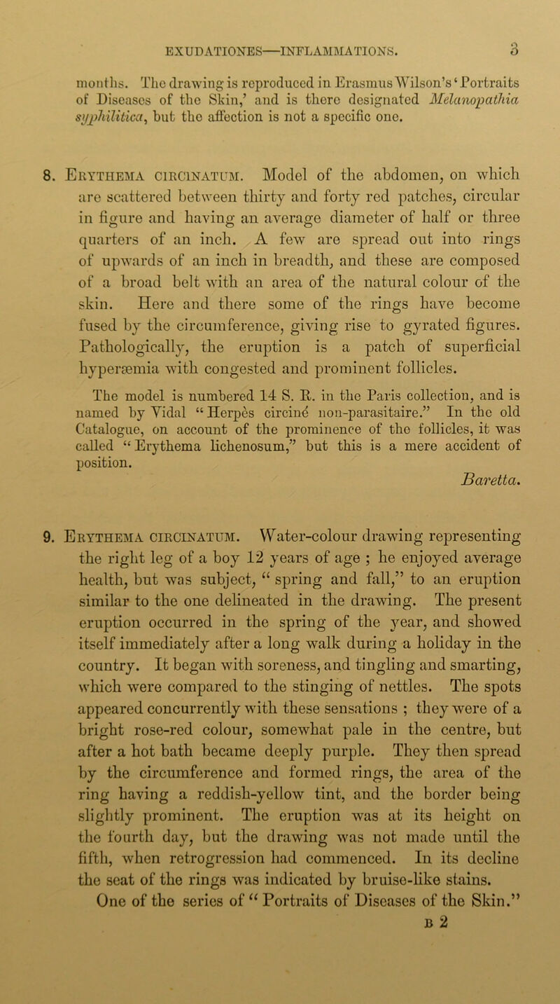 months. The drawing is reproduced in Erasmus Wilson’s ‘ Portraits of Diseases of the Skin,’ and is there designated Melanopathia syphilitica^ but the affection is not a specific one. 8. Erythema circinatum. Model of the abdomeiij on which are scattered between thirty and forty red patches, circular in figure and having an average diameter of half or three quarters of an inch. A few are spread out into rings of upwards of an inch in breadth, and these are composed of a broad belt with an area of the natural colour of the skin. Here and there some of the rings have become fused by the circumference, giving rise to gyrated figures. Pathologically, the eruption is a patch of superficial hypersemia with congested and prominent follicles. The model is numbered 14 S. R. in the Paris collection, and is named by Yidal “ Herpes circine uon-parasitaire.” In the old Catalogue, on account of the prominence of the follicles, it was called “Erythema lichenosum,” but this is a mere accident of position. Baretta. 9. Erythema circinatum. Water-colour drawing representing the right leg of a boy 12 years of age ; he enjoyed average health, but was subject, “ spring and fall,” to an eruption similar to the one delineated in the drawing. The present eruption occurred in the spring of the year, and showed itself immediately after a long walk during a hohday in the country. It began with soreness, and tingling and smarting, which were compared to the stinging of nettles. The spots appeared concurrently with these sensations ; they were of a bright rose-red colour, somewhat pale in the centre, but after a hot bath became deeply purple. They then spread by the circumference and formed rings, the area of the ring having a reddish-yellow tint, and the border being slightly prominent. The eruption was at its height on the fourth day, but the drawing was not made until the fifth, when retrogression had commenced. In its decline the seat of the rings was indicated by bruise-hke stains. One of the series of Portraits of Diseases of the Skin.” B 2