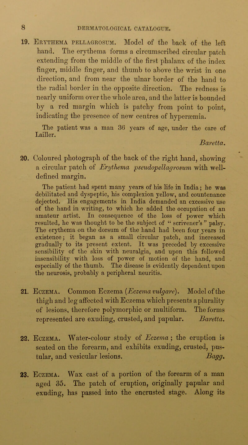 19. Erythema pellagrosum. Model of the back of the left hand. The erythema forms a circumscribed circular patch extending from the middle of the first phalanx of the index finger, middle finger, and thumb to above the wrist in one direction, and from near the ulnar border of the hand to the radial border in the opposite direction. The redness is nearly uniform over the whole area, and the latter is bounded by a red margin which is patchy from point to point, indicating the presence of new centres of hypersemia. The patient was a man 36 years of age, under the care of Lailler. Baretta. 20. Coloured photograph of the back of the right hand, showing a circular patch of Erythema pseudopellagrosum with well- defined margin. The patient had spent many years of his life in India; he was debilitated and dyspeptic, his complexion yellow, and countenance dejected. His engagements in India demanded an excessive use of the hand in writing, to which he added the occupation of an amateur artist. In consequence of the loss of power which resulted, he was thought to he the subject of “ scrivener’s ” palsy. The erythema on the dorsum of the hand had been four years in existence; it began as a small circular patch, and increased gradually to its present extent. It was preceded by excessive sensibility of the skin with neuralgia, and upon this followed insensibility with loss of power of motion of the hand, and especially of the thumb. The disease is evidently dependent upon the neurosis, probably a peripheral neuritis. 21. Eczema. Qovamon^czemsi {Eczema vulgare). Model of the thigh and leg affected with Eczema which presents a plurality of lesions, therefore polymorphic or multiform. The forms represented are exuding, crusted, and papular. Baretta. 22. Eczema. Water-colour study of Eczema; the eruption is seated on the forearm, and exhibits exuding, crusted, pus- tular, and vesicular lesions. Bagg, 23. Eczema. Wax cast of a portion of the forearm of a man aged 35. The patch of eruption, originally papular and exuding, has passed into the encrusted stage. Along its