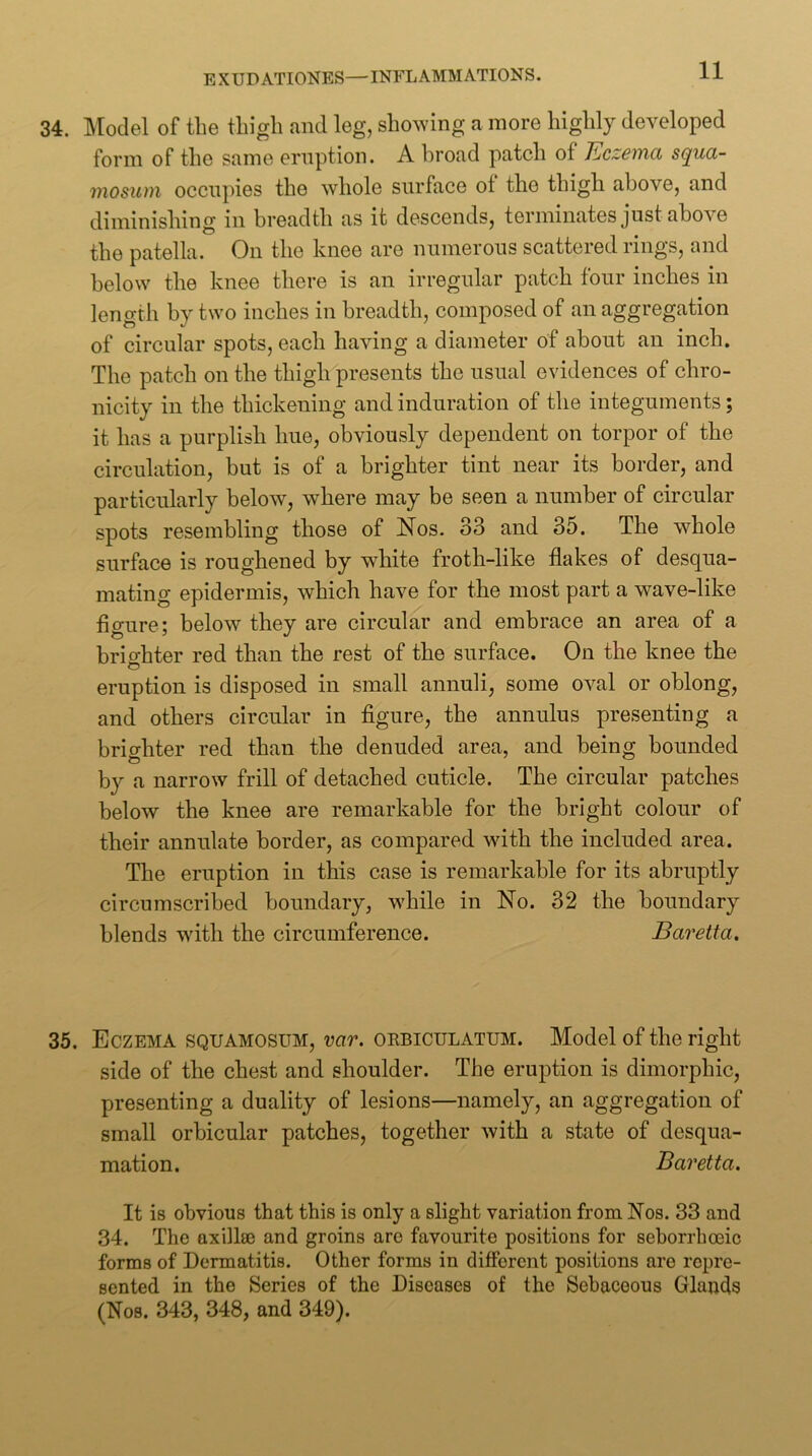 34. Model of the thigh and leg, showing a more highly developed form of the same eruption. A broad patch of Eczema squa- mosum occupies the whole surface ot the thigh above, and diminishing in breadth as it descends, terminates just above the patella. On the knee are numerous scattered rings, and below the knee there is an irregular patch four inches in length by two inches in breadth, composed of an aggregation of circular spots, each having a diameter of about an inch. The patch on the thigh presents the usual evidences of chro- nicity in the thickening and induration of the integuments; it has a purplish hue, obviously dependent on torpor of the circulation, but is of a brighter tint near its border, and particularly below, where may be seen a number of circular spots resembling those of Nos. 33 and 35. The whole surface is roughened by white froth-like flakes of desqua- mating epidermis, which have for the most part a wave-like flgure; below they are circular and embrace an area of a brio-hter red than the rest of the surface. On the knee the O eruption is disposed in small annuli, some oval or oblong, and others circular in flgure, the annulus presenting a brighter red than the denuded area, and being bounded by a narrow frill of detached cuticle. The circular patches below the knee are remarkable for the bright colour of their annulate border, as compared with the included area. The eruption in this case is remarkable for its abruptly circumscribed boundary, while in No. 32 the boundary blends with the circumference. Baretta. 35. Eczema squamosum, var. orbiculatum. Model of the right side of the chest and shoulder. The eruption is dimorphic, presenting a duality of lesions—namely, an aggregation of small orbicular patches, together with a state of desqua- mation. Baretta. It is obvious that this is only a slight variation from. Nos. 33 and 34. The axillae and groins are favourite positions for seborrhoeic forms of Dermatitis. Other forms in different positions are repre- sented in the Series of the Diseases of the Sebaceous Glands (Nos. 343, 348, and 349).