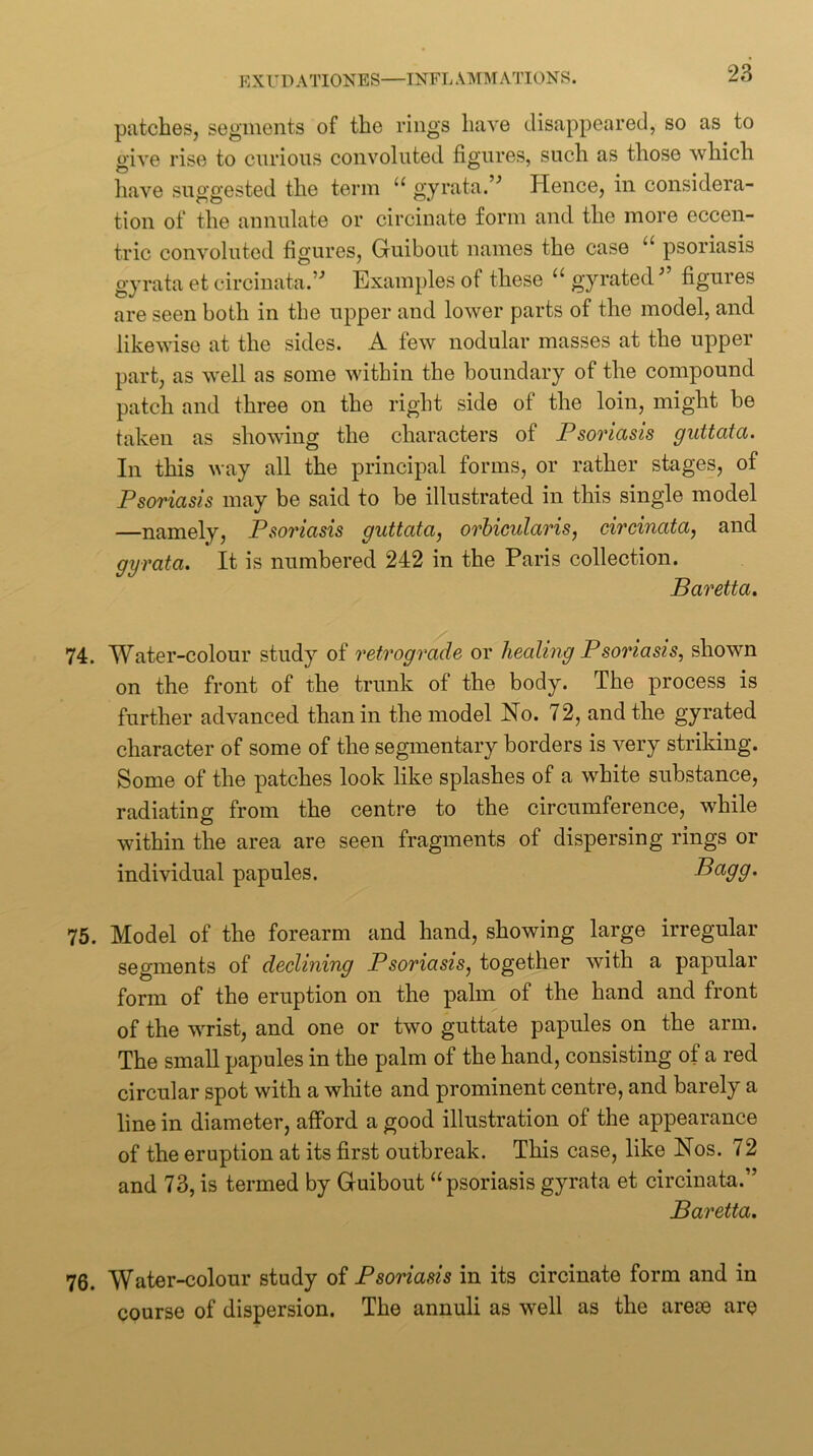 patches, segments of the rings have disappeared, so as to give rise to curious convoluted figures, such as those which liave suggested the term “ gyrata.’^ Hence, in considera- tion of the annulate or circinate form and the more eccen- tric convoluted figures, Guibout names the case psoriasis gyrata et circiuata.’ Examples of these gyratedfigures are seen both in the upper and lower parts of the model, and likewise at the sides. A few nodular masses at the upper part, as well as some within the boundary of the compound patch and three on the right side of the loin, might be taken as showing the characters of Psoriasis guttata. In this way all the principal forms, or rather stages, of Psoriasis may be said to be illustrated in this single model —namely. Psoriasis guttata, orbicularis, circinata, and gyrata. It is numbered 242 in the Paris collection. Baretta. 74. Water-colour study of retrograde or healing Psoriasis, shown on the front of the trunk of the body. The process is further advanced than in the model No. 72, and the gyrated character of some of the segmentary borders is very striking. Some of the patches look like splashes of a white substance, radiating from the centre to the circumference, while within the area are seen fragments of dispersing rings or individual papules. ^<^99' 75. Model of the forearm and hand, showing large irregular segments of declining Psoriasis, together with a papular form of the eruption on the palm of the hand and front of the wrist, and one or two guttate papules on the arm. The small papules in the palm of the hand, consisting of a red circular spot with a white and prominent centre, and barely a line in diameter, afford a good illustration of the appearance of the eruption at its first outbreak. This case, like Nos. 72 and 73, is termed by Guibout “psoriasisgyrata et circinata.” Baretta. 76. Water-colour study of Psoriasis in its circinate form and in course of dispersion. The annuli as well as the arese are