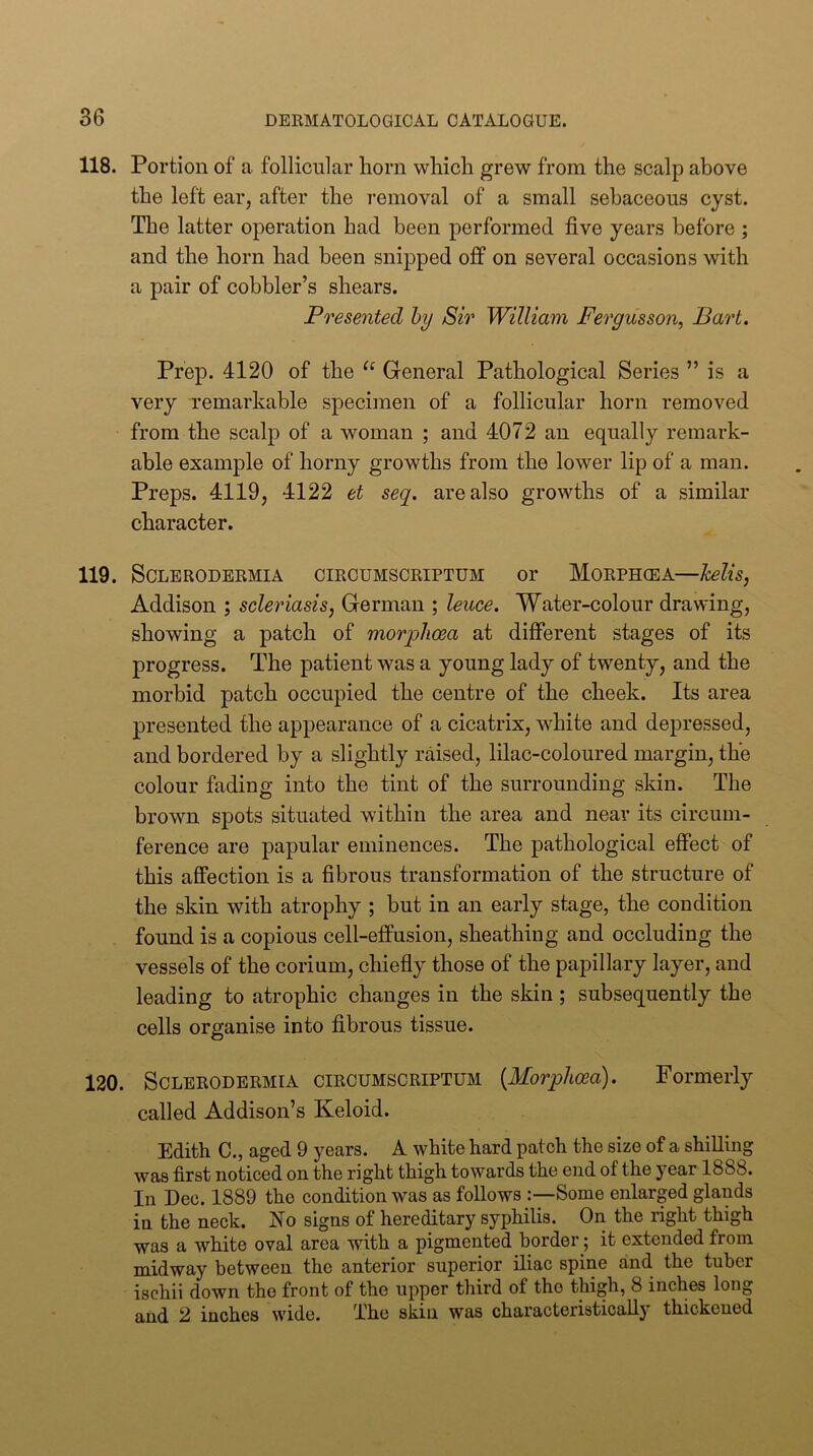 118. Portion of a follicular horn which grew from the scalp above the left ear, after the removal of a small sebaceous cyst. The latter operation had been performed five years before ; and the horn had been snip>ped off on several occasions with a pair of cobbler’s shears. Presented hy Sir William Fergusson, Bart. Prep. 4120 of the General Pathological Series ” is a very remarkable specimen of a follicular horn removed from the scalp of a woman ; and 4072 an equally remark- able example of horny growths from the lower lip of a man. Preps. 4119, 4122 et seq. are also growths of a similar character. 119. SCLERODERMIA CIRCUMSCRIPTUM or MoRPH(EA—helis, Addison ; scleriasis, German ; leuce. Water-colour drawing, showing a patch of morphoea at different stages of its progress. The patient was a young lady of twenty, and the morbid patch occupied the centre of the cheek. Its area presented the appearance of a cicatrix, white and depressed, and bordered by a slightly raised, lilac-coloured margin, the colour fading into the tint of the surrounding skin. The brown spots situated within the area and near its circum- ference are papular eminences. The pathological effect of this affection is a fibrous transformation of the structure of the skin with atrophy ; but in an early stage, the condition found is a copious cell-effusion, sheathing and occluding the vessels of the corium, chiefly those of the papillary layer, and leading to atrophic changes in the skin; subsequently the cells organise into fibrous tissue. 120. SCLERODERMIA CIRCUMSCRIPTUM {Morplioea). Formerly called Addison’s Keloid. Edith C., aged 9 years. A white hard patch the size of a shilling was first noticed on the right thigh towards the end of the year 1888. In Dec. 1889 the condition was as follows Some enlarged glands in the neck. No signs of hereditary syphilis. On the right thigh was a white oval area with a pigmented border; it extended from midway between the anterior superior iliac spine and the tuber ischii down the front of the upper third of the thigh, 8 inches long and 2 inches wide. The skin was characteristically thickened