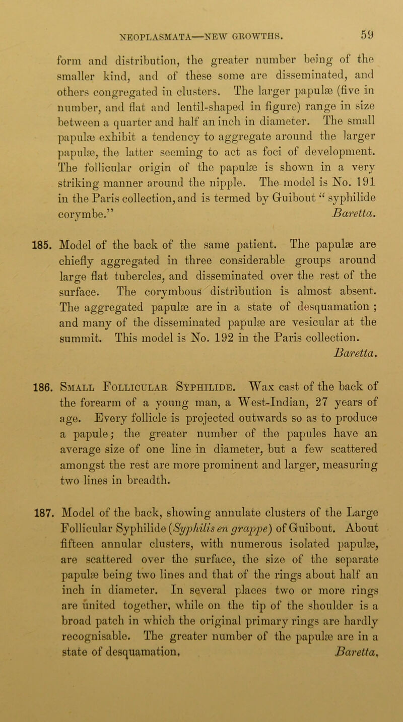 form and distribution, the greater number being of tlie smaller kind, and of these some are disseminated, and others congregated in clusters. The larger papulje (five in number, and flat and lentil-shaped in figure) range in size between a quarter and half an inch in diameter. The small papulm exhibit a tendency to aggregate around the larger papulre, the latter seeming to act as foci of development. The follicular origin of the papulaa is shown in a very striking manner around the nipple. The model is No. 191 in the Paris collection, and is termed by Guibout syphilide coryrnbe.” Baretta, V 185. Model of the back of the same patient. The papulae are chiefly aggregated in three considerable groups around large flat tubercles, and disseminated over the rest of the surface. The corymbous distribution is almost absent. The aggregated papulae are in a state of desquamation ; and many of the disseminated papulae are vesicular at the summit. This model is No. 192 in the Paris collection. Baretta. 186. Small Follicular Syphilide. Wax cast of the back of the forearm of a young man, a West-Indian, 27 years of age. Every follicle is projected outwards so as to produce a papule; the greater number of the papules have an average size of one line in diameter, but a few scattered amongst the rest are more prominent and larger, measuring two lines in breadth. 187. Model of the back, showing annulate clusters of the Large Follicular Syphilide {Syphilis en grappe) of Guibout. About fifteen annular clusters, with numerous isolated papulae, are scattered, over the surface, the size of the separate papulae being two lines and that of the rings about half an inch in diameter. In several places two or more rings are united together, while on the tip of the shoulder is a broad patch in which the original primary rings are hardly recognisable. The greater number of the papulae are in a state of desquamation, Baretta,