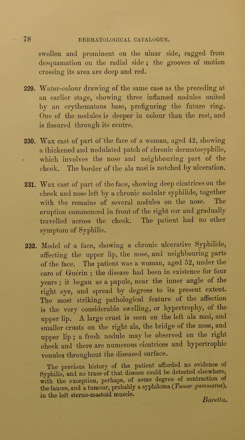 swollen and prominent on the ulnar side, ragged from desquamation on the radial side ; the grooves of motion crossing its area are deep and red. 229. Water-colour drawing of the same case as the preceding at an earlier stage,' showing three inflamed nodules united by an erythematous base, prefiguring the future ring. One of the nodules is deeper in colour than the rest, and is fissured through its centre. 230. Wax cast of part of'the face of a woman, aged 42, showing a thickened and nodulated patch of chronic dermatosyphilis, > which involves the nose and neighbouring part of the cheek. The border of the ala nasi is notched by ulceration. 231. Wax cast of part of the face, showing deep cicatrices on the cheek and nose left by a chronic nodular syphilide, together with the remains of several nodules on the nose. The eruption commenced in front of the right ear and gradually travelled across the cheek. The patient had no other symptom of Syphilis. 232. Model of a face, showing a chronic ulcerative Syphilide, affecting the upper lip, the nose, and neighbouring parts of the face. The patient was a woman, aged 52, under the care of Guerin ; the disease had been in existence for four years ; it began as a papule, near the inner angle of the right eye, and spread by degrees to its present extent. The most striking pathological feature of the affection is the very considerable swelling, or hypertrophy, of the upp0r lip. large crust is seen on the left ala nasi, and smaller crusts on the right ala, the bridge of the nose, and upper lip ; a fresh nodule may be observed on the right cheek and there are numerous cicatrices and hypeitrophic venules throughout the diseased surface. The previous history of the patient afforded no evidence of Syphilis, and no trace of that disease could be detected elsewhere, with the exception, perhaps, of some degree of contraction of the fauces, and a tumour, probably a syphiloma {Tumor gummatus), in the left sterno-mastoid muscle.