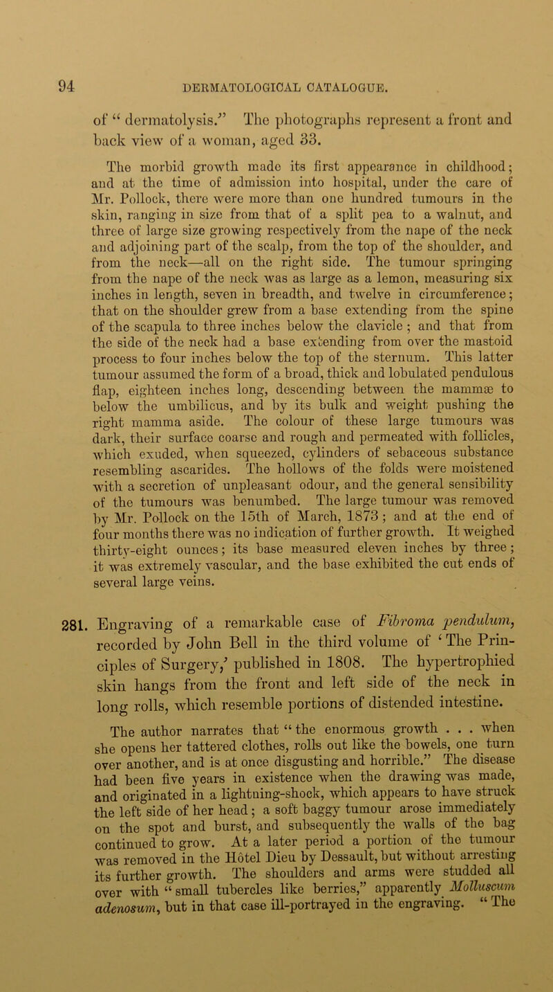 of “ dermatolysis.'” The photographs represent a front and back view of a woman, aged 33. The morbid growth made its first appearance in childhood; and at the time of admission into hospital, under the care of Mr. Pollock, there were more than one hundred tumours in the skin, ranging in size from that of a split pea to a walnut, and three of large size growing respectively from the nape of the neck and adjoining part of the scalp, from the top of the shoulder, and from the neck—all on the right side. The tumour springing from the nape of the neck was as large as a lemon, measuring six inches in length, seven in breadth, and twelve in circumference; that on the shoulder grew from a base extending from the spine of the scapula to three inches below the clavicle ; and that from the side of the neck had a base extending from over the mastoid process to four inches below the top of the sternum. This latter tumour assumed the form of a broad, thick and lobulated pendulous flap, eighteen inches long, descending between the mammae to below the umbilicus, and by its bulk and weight pushing the right mamma aside. The colour of these large tumours was dark, their surface coarse and rough and permeated with follicles, which exuded, when squeezed, cylinders of sebaceous substance resembling ascarides. The hollows of the folds were moistened with a secretion of unpleasant odour, and the general sensibility of the tumours was benumbed. The large tumour was removed by Mr. Pollock on the 15th of March, 1873; and at the end of four months there was no indication of further growth. It weighed thirty-eight ounces; its base measured eleven inches by three; it was extremely vascular, and the base exhibited the cut ends of several large veins. 281. Engraving of a remarkable case of Fitvomci pcnduluiii) recorded by John Bell in the third volume of ‘ The Prin- ciples of Surgery/ published in 1808. The hypertrophied skin hangs from the front and left side of the neck in long rolls, which resemble portions of distended intestine. The author narrates that “ the enormous growth . . . when she opens her tattered clothes, rolls out like the bowels, one _ turn over another, and is at once disgusting and horrible.” The disease had been five years in existence when the drawing was made, and originated in a lightning-shock, which appears to have struck the left side of her head; a soft baggy tumour arose immediately on the spot and burst, and subsequently the walls of the bag continued to grow. At a later period a portion of the tumour was removed in the Hotel Dieu by Dessault, but without arresting its further growth. The shoulders and arms were studded all over with “ small tubercles like berries,” apparently Molluscum adenosum, but in that case ill-portrayed in the engraving. “ The