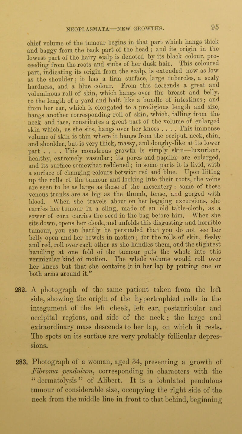 chief volume of the tumour begins in that part which hangs thick and baggy from the back part of the head ; and its origin in the lowest part of the hairy scalp is denoted by its black colour, pro- ceeding from the roots and stubs of her dusk hair. This coloured part, indicating its origin from the scalp, is extended now as low as the shoulder ; it has a firm surface, large tubercles, a scaly hardness, and a blue colour. From this deocends a great and voluminous roll of skin, which hangs over the breast and belly, to the length of a yard and half, like a bundle of intestines ; and from her ear, which is elongated to a prodigious length and size, hangs another corresponding roll of skin, which, falling from the neck and face, constitutes a great part of the volume of enlarged skin which, as she sits, hangs over her knees .... This immense volume of skin is thin where it hangs from the occiput, neck, chin, and shoulder, but is very thick, massy, and doughy-like at its lower part .... This monstrous growth is simply skin—luxuriant, healthy, extremely vascular; its pores and papillae are enlarged, and its surface somewhat reddened; in some parts it is livid, with a surface of changing colours betwixt red and blue. TJpon lifting up the rolls of the tumour and looking into their roots, the veins are seen to be as large as those of the mesentery : some of these venous trunks are as big as the thumb, tense, and gorged with blood. When she travels about on her begging excursions, she carries her tumour in a sling, made of an old table-cloth, as a sower of corn carries the seed in the bag before him. When she sits down, opens her cloak, and unfolds this disgusting and horrible tumour, you can hardly be persuaded that you do not see her belly open and her bowels in motion; for the rolls of skin, fleshy and red, roll over each other as she handles them, and the slightest handling at one fold of the tumour puts the whole into this vermicular kind of motion. The whole volume would roll over her knees but that she contains it in her lap by putting one or both arms around it.” 282. A photograph of the same patient taken from the left side, showing the origin of the hypertrophied rolls in the integument of the left cheek, left ear, postaiiriciilar and occipital regions, and side of the neck ; the large and extraordinary mass descends to her lap, on which it rests. The spots on its surface are very probably follicular depres- sions. 283. Photograph of a woman, aged 34, presenting a growth of Fibroma pendulum^ corresponding in characters with the dermatolysis ” of Alibert. It is a lobulated pendulous tumour of considerable size, occupying the right side of the neck from the middle line in front to that behind, befrinninii' / O O