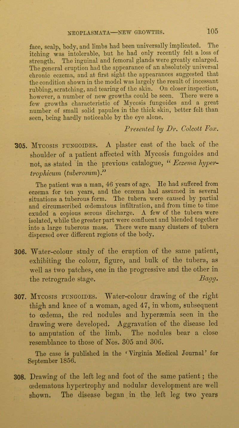 face, scalp, body, and limbs bad been universally implicated. The itching was intolerable, but he had only recently felt a loss of strength. The inguinal and femoral glands were greatly enlarged. The general eruption had the appearance of an absolutely universal chronic eczema, and at first sight the appearances suggested that the condition shown in the model was largely the result of incessant rubbing, scratching, and tearing of the skin. On closer inspection, however, a number of new growths could be seen. There were a few growths characteristic of Mycosis fungoides and a great number of small solid papules in the thick skin, better felt than seen, being hardly noticeable by the eye alone. Presented hy Dr. Colcott Fo.r. 305. Mycosis fungoides. A plaster cast of the back of the shoulder of a patient affected wdth Mycosis fungoides and not, as stated 'in the previous catalogue, Eczema hype'll trophieum {tuberosum) The patient was a man, 46 years of age. He had suffered from eczema for ten years, and the eczema had assumed in several situations a tuberous form. The tubera were caused by partial and circumscribed oedematous infiltration, and from time to time exuded a copious serous discharge. A few of the tubera were isolated, while the greater part were confluent and blended together into a large tuberous mass. There were many clusters of tubera dispersed over different regions of the body. 306. Water-colour study of the eruption of the same patient, exhibiting the colour, figure, and bulk of the tubera, as well as two patches, one in the progressive and the other in the retrograde stage. Dagg. 307. Mycosis fungoides. Water-colour drawing of the right thigh and knee of a wmman, aged 47, in whom, subsequent to oedema, the red nodules and hypersemia seen in the drawing were developed. Aggravation of the disease led to amputation of the limb. The nodules bear a close resemblance to those of Nos. 305 and 306. The case is pubhshed in the ‘Virginia Medical Journal’ for September 1856. 308. Drawing of the left leg and foot of the same patient; the oedematous hypertrophy and nodular development are well shown. The disease began , in the left leg t^vo years